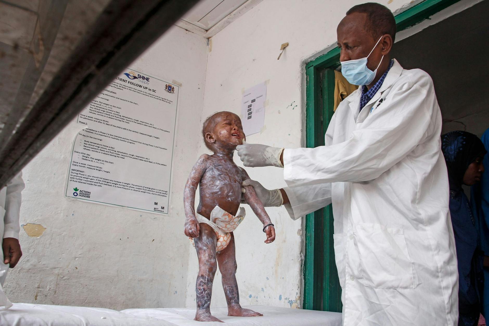 dpatopbilder - Ein Arzt in Mogadischu trägt Hautcreme auf ein Kind auf, das Symptome von Kwashiorkor zeigt, einer schweren Eiweißunterernährung, die Schwellungen und Hautläsionen verursacht.