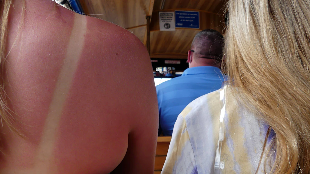 DARUM sollten Sie niemals mit Sonnenbrand in die Sonne gehen – und DAS sind die Alternativen im Sommerurlaub