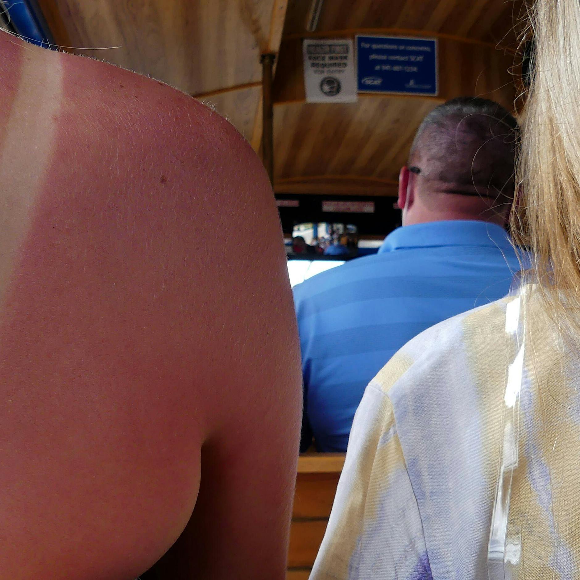 DARUM sollten Sie niemals mit Sonnenbrand in die Sonne gehen – und DAS sind die Alternativen im Sommerurlaub