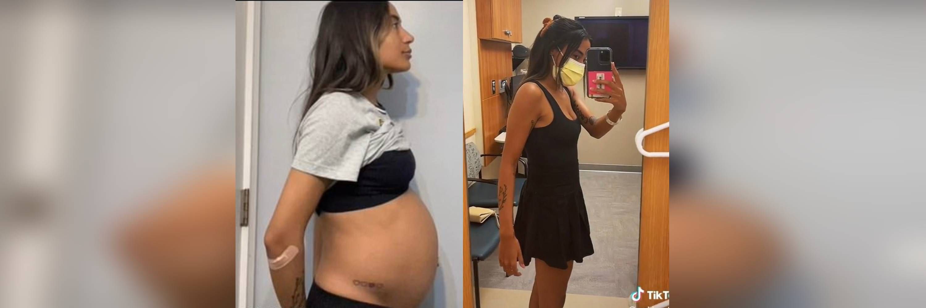 Image - Sie hatte 5 Jahre lang Schmerzen beim Sex: Jetzt wurde Raquel Rodriguez eine riesige 4-Kilo-Zyste entfernt!