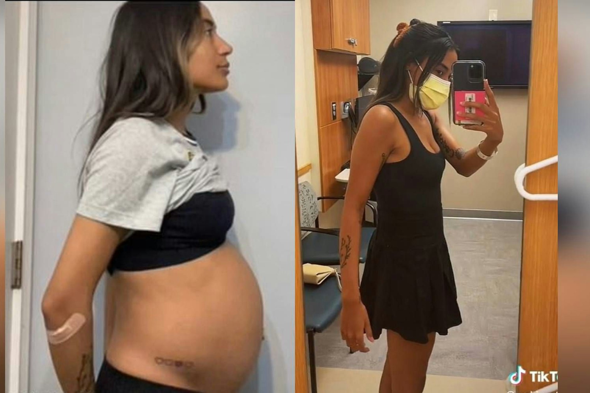 Raquel Rodriguez vor der Entfernung ihrer Zyste (li.) und zwei Wochen danach.