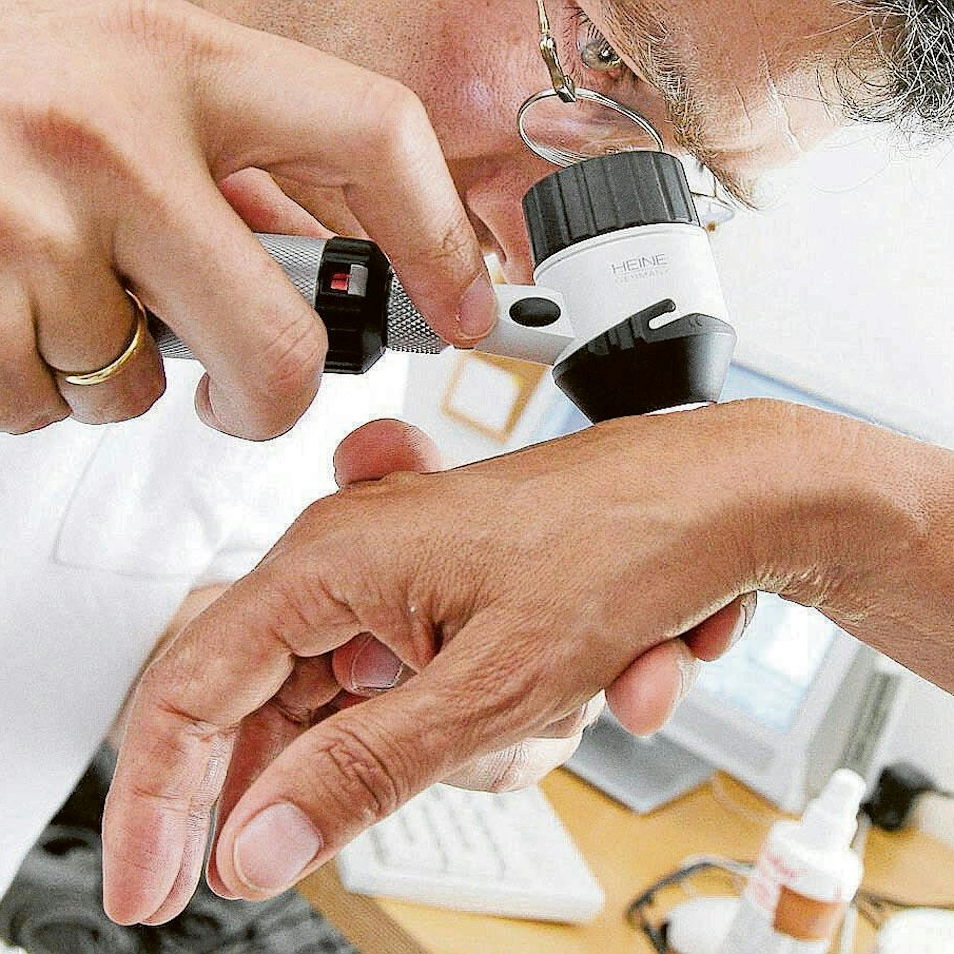 Leberflecken, raue Stellen: Habe ich Hautkrebs? Was muss ich jetzt tun?