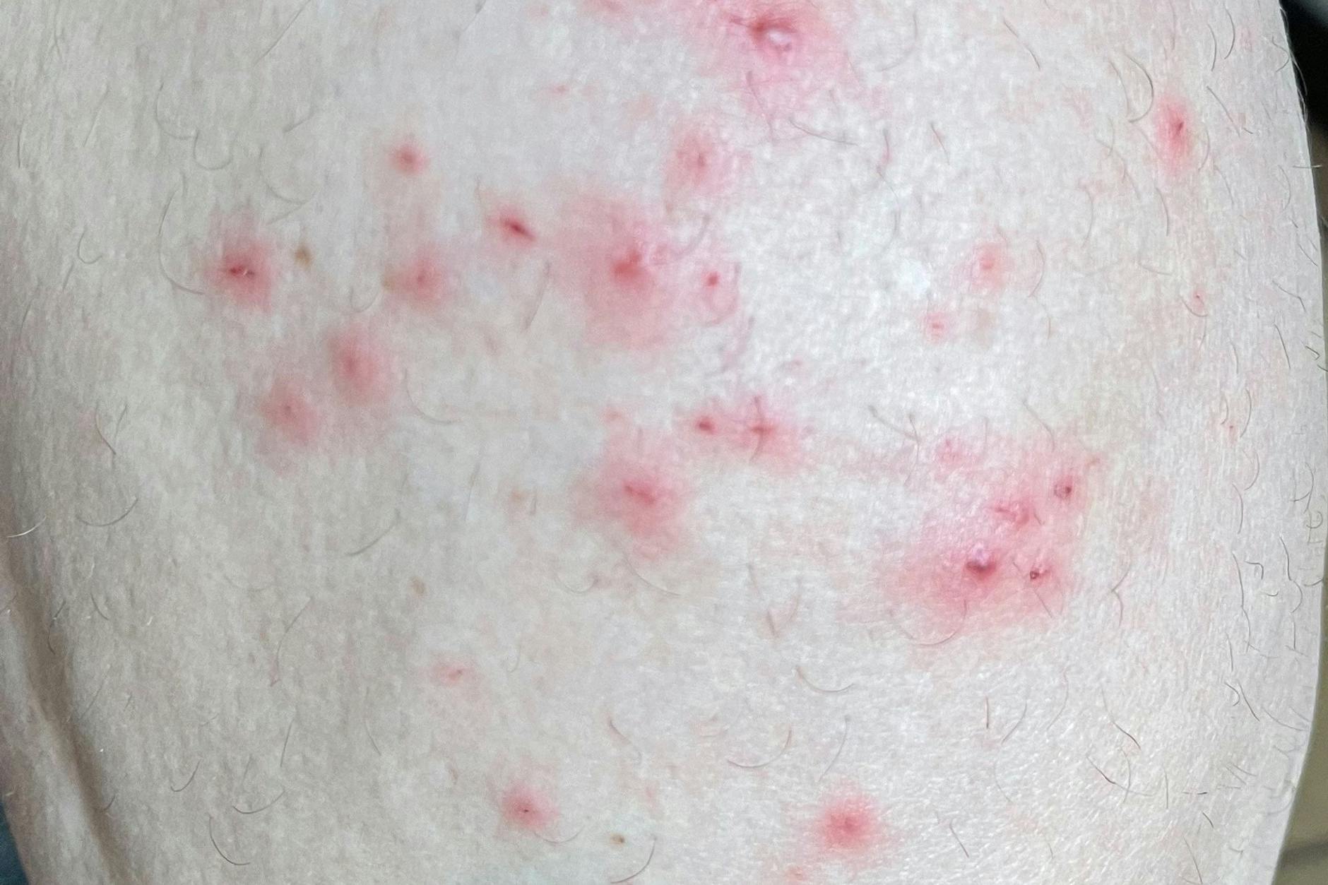 Hautsymptome von Affenpocken-Patienten.