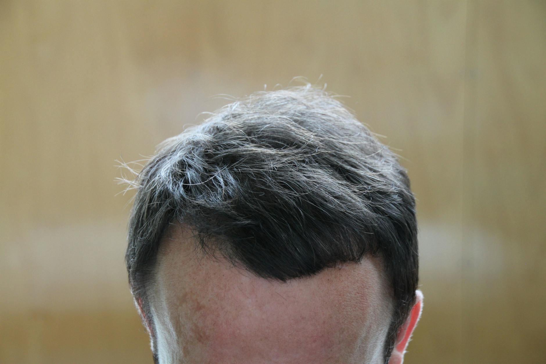 Der selbe Patient wie auf dem Foto ganz oben: Nach der PRP-Behandlung wachsen die Haare wieder.