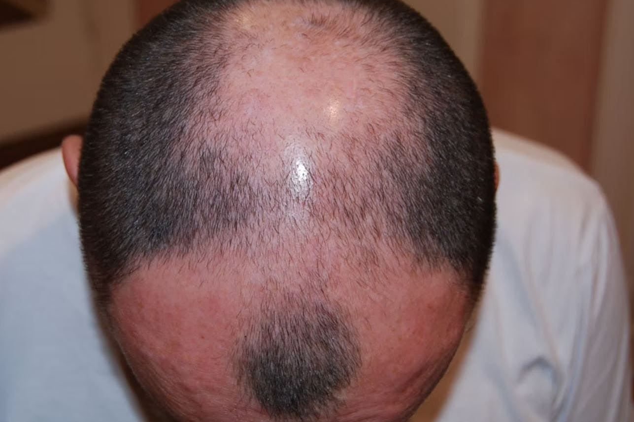 Haarausfall empfinden viele Menschen als störend.