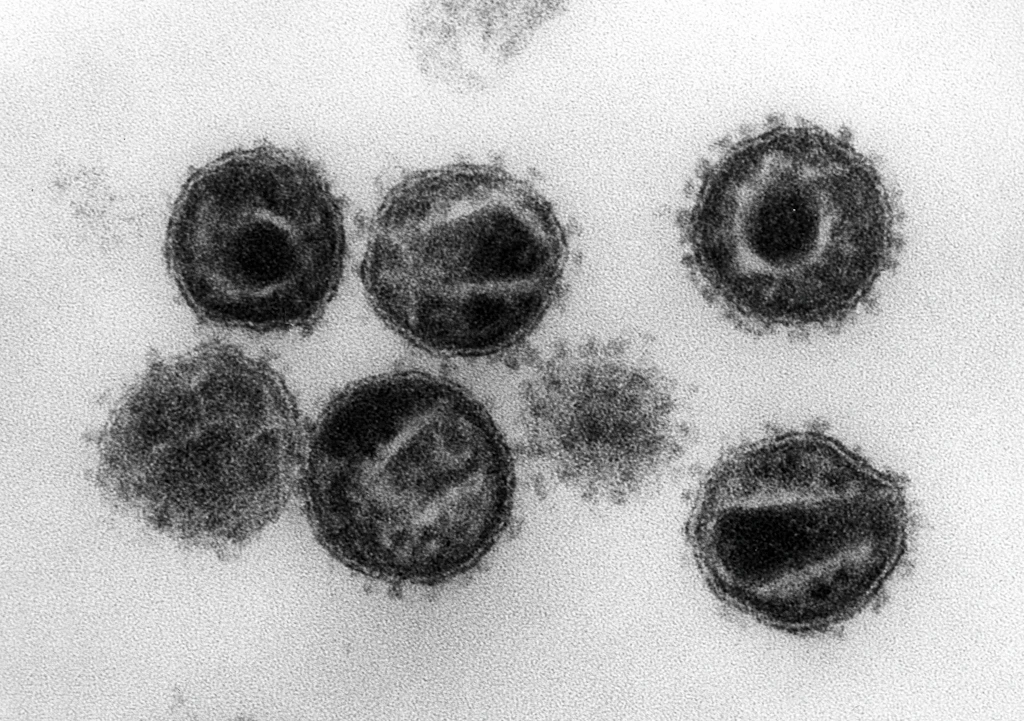 Weiterer Patient offenbar von HIV geheilt