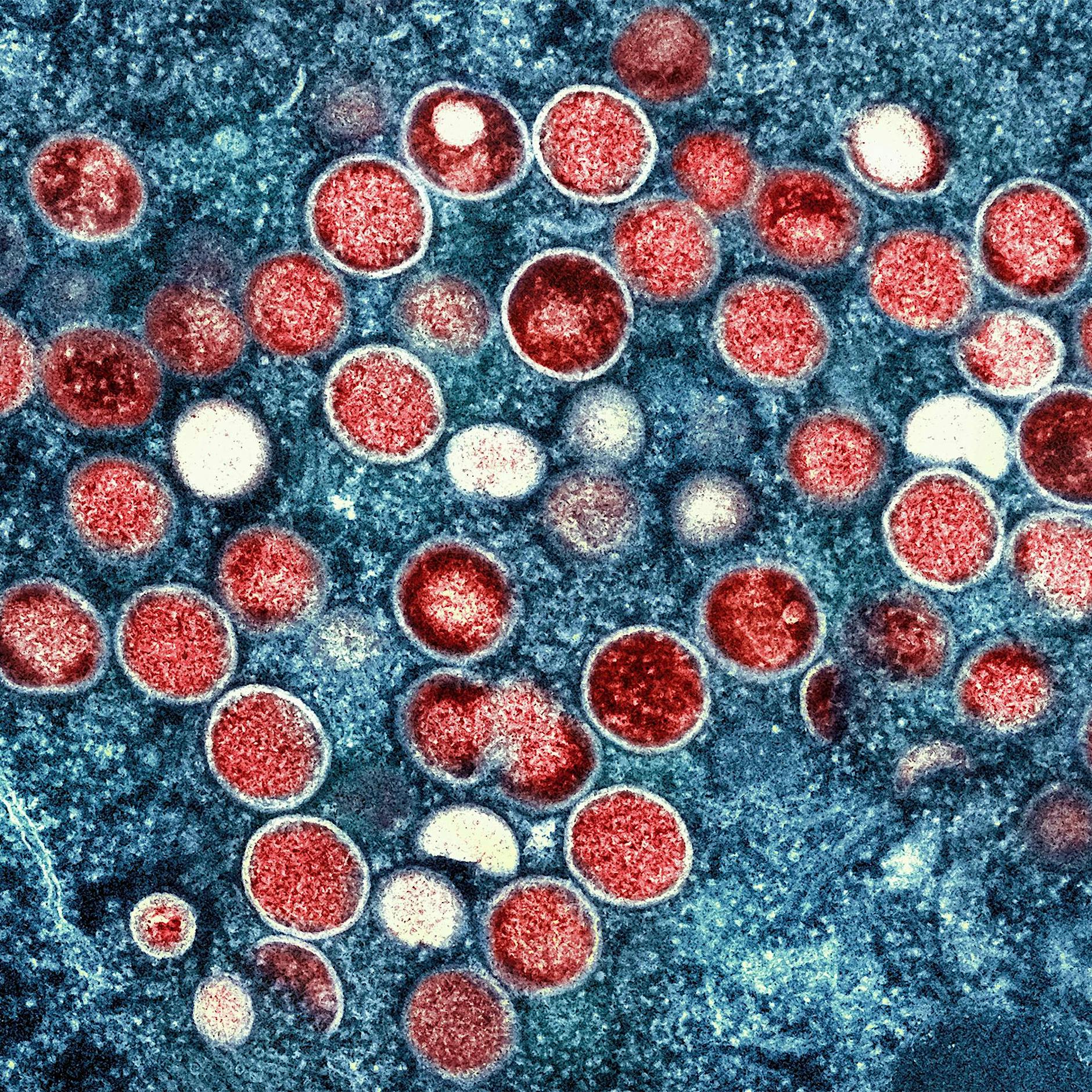 WHO rechnet mit baldigem Ende des Affenpocken-Ausbruchs