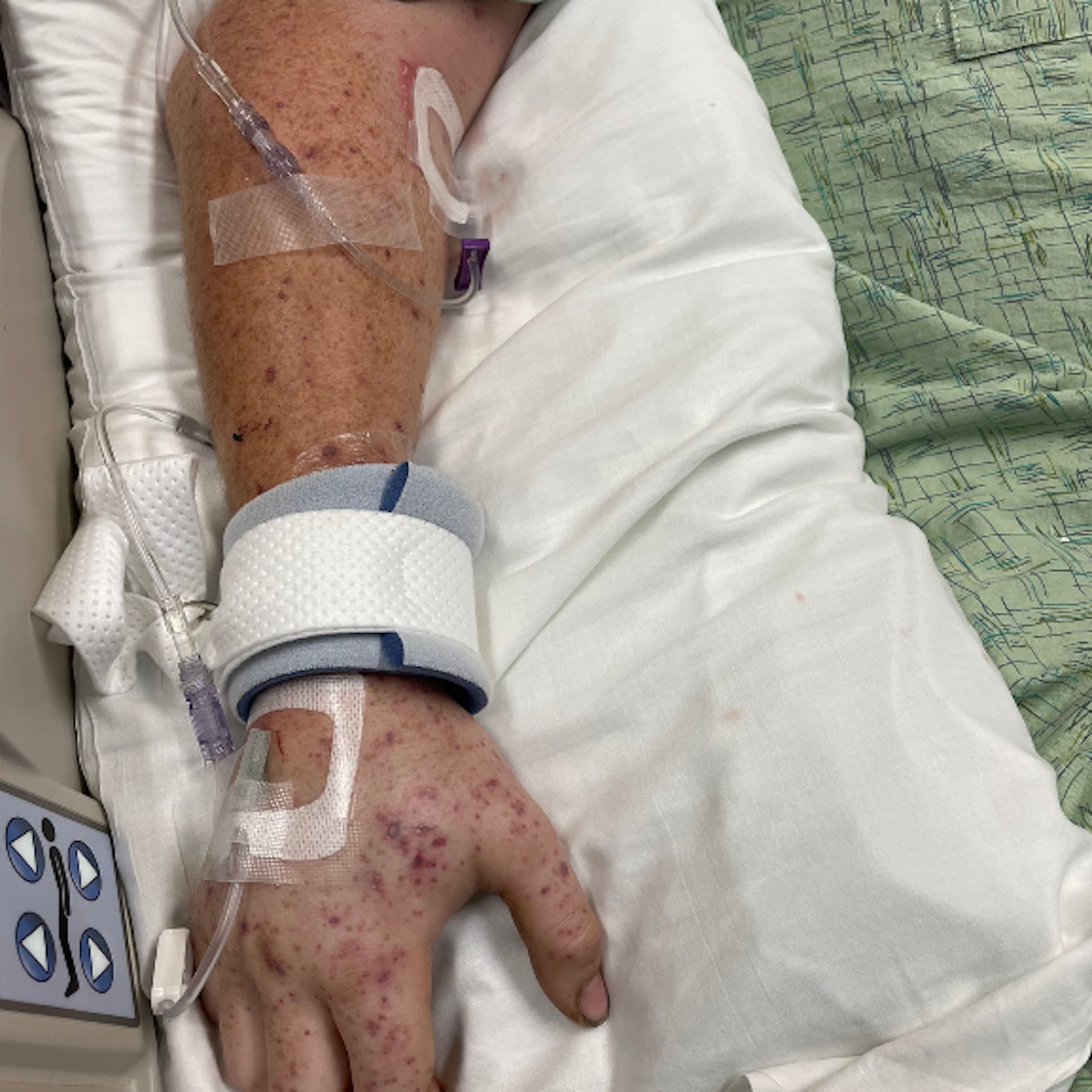 Der 20-jährige Austin Bellamy wurde von 20.000 Killer-Bienen angegriffen, liegt nun im künstlichen Koma.