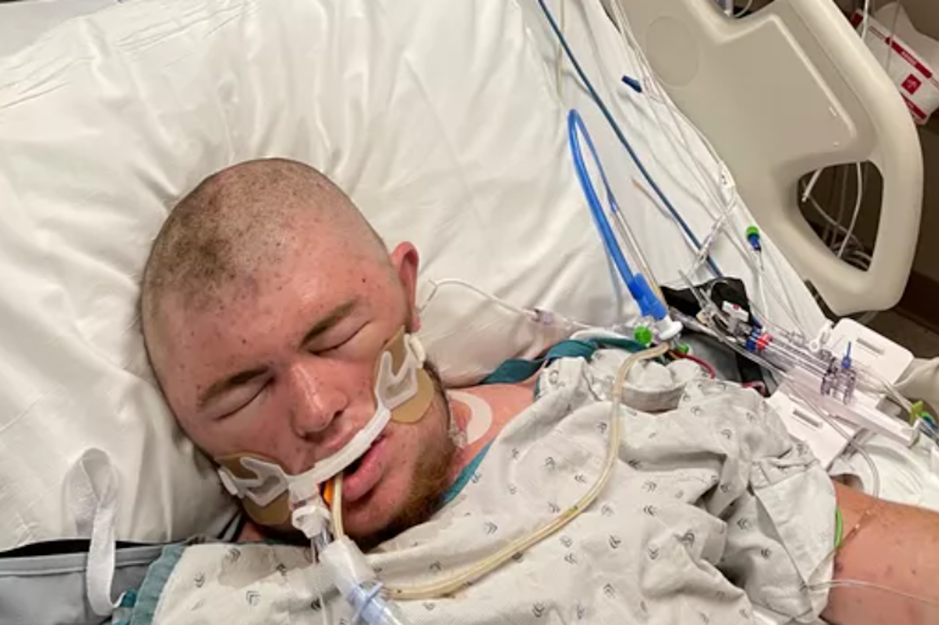 Nach einer Attacke von 20.000 Killer-Bienen liegt ein 20-Jähriger in den USA im Koma.