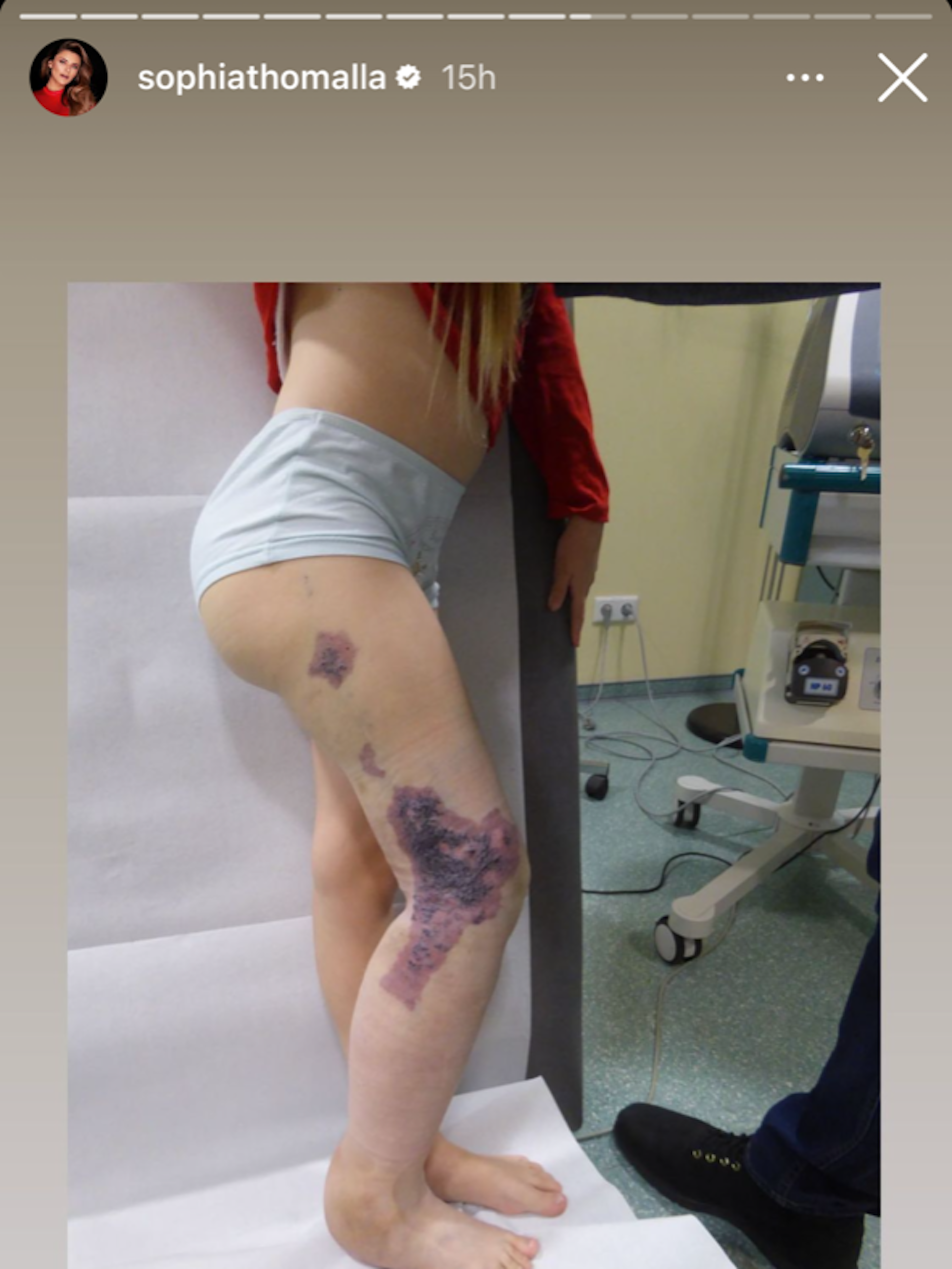 Sophia Thomalla spricht jetzt erstmals öffentlich über ihre Krankheit, die venöse Malformation, unter der auch Kira leidet. Sophia Thomalla will dem russischen Mädchen helfen.