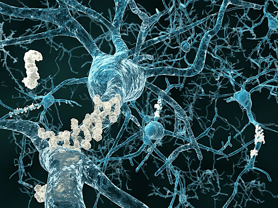 ARCHIV - Eiweißablagerungen zwischen den Nervenzellen (Plaques) sind zum Teil ursächlich für Alzheimer-Symptome.  