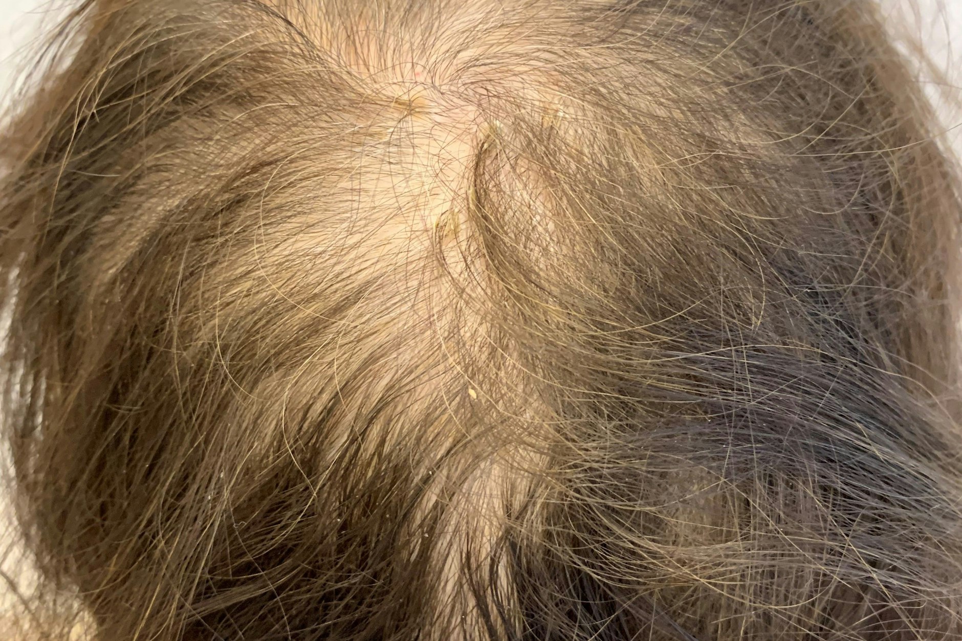 Haarausfall bei Frauen Warum Extensions Gift sind, wie man volles Haar bekommt