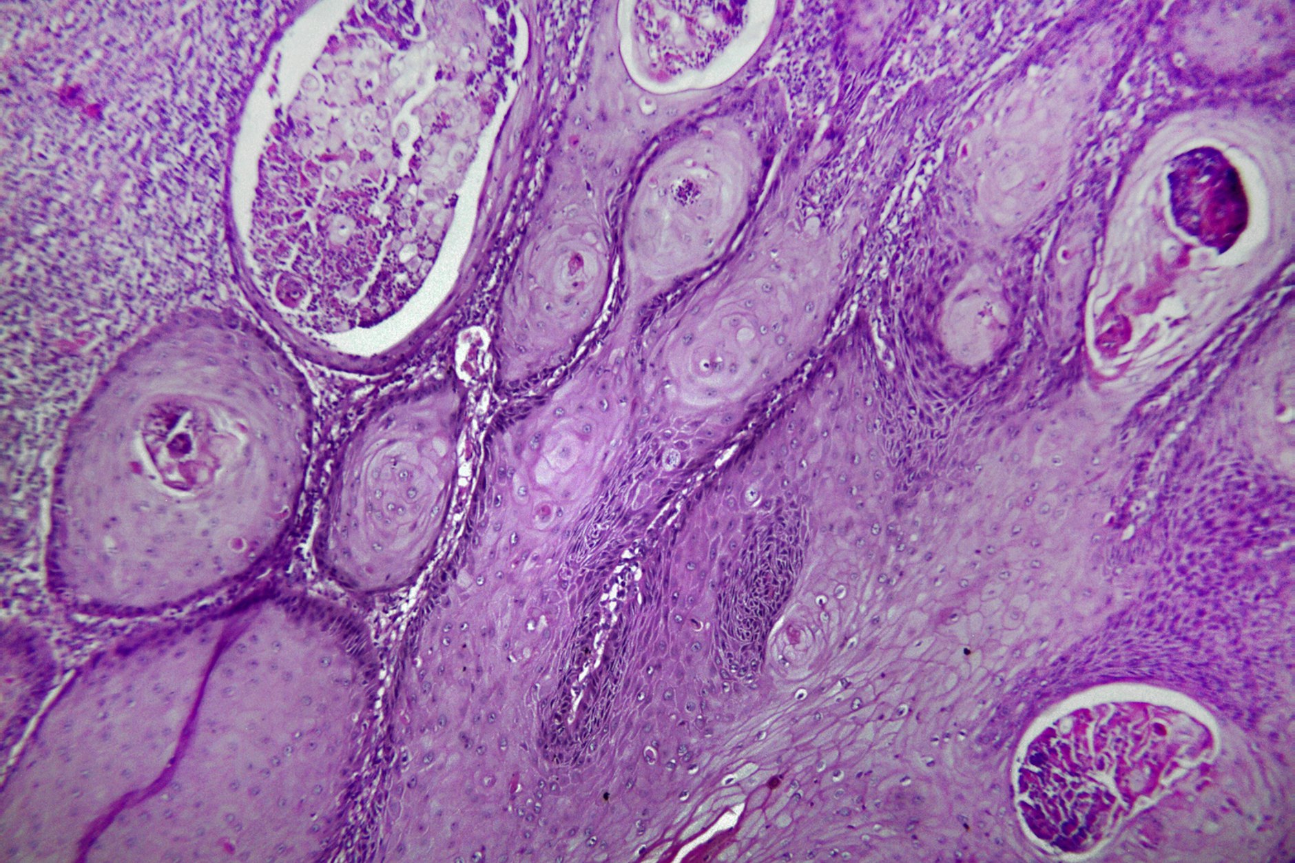 Hautkrebs unter dem Elektronenmikroskop: Eine Substanz im Tumor ist in der Lage, Metastasen zu verhindern.