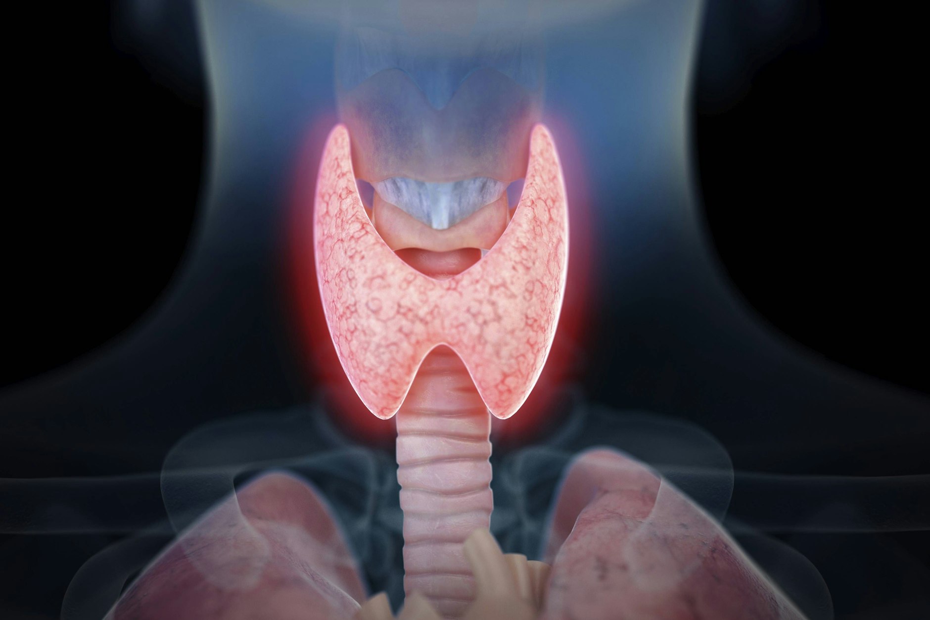 Abbildung einer entzündeten Schilddrüse: Bei Hashimoto kann das schmetterlingsförmige Organ immer weiter schrumpfen.