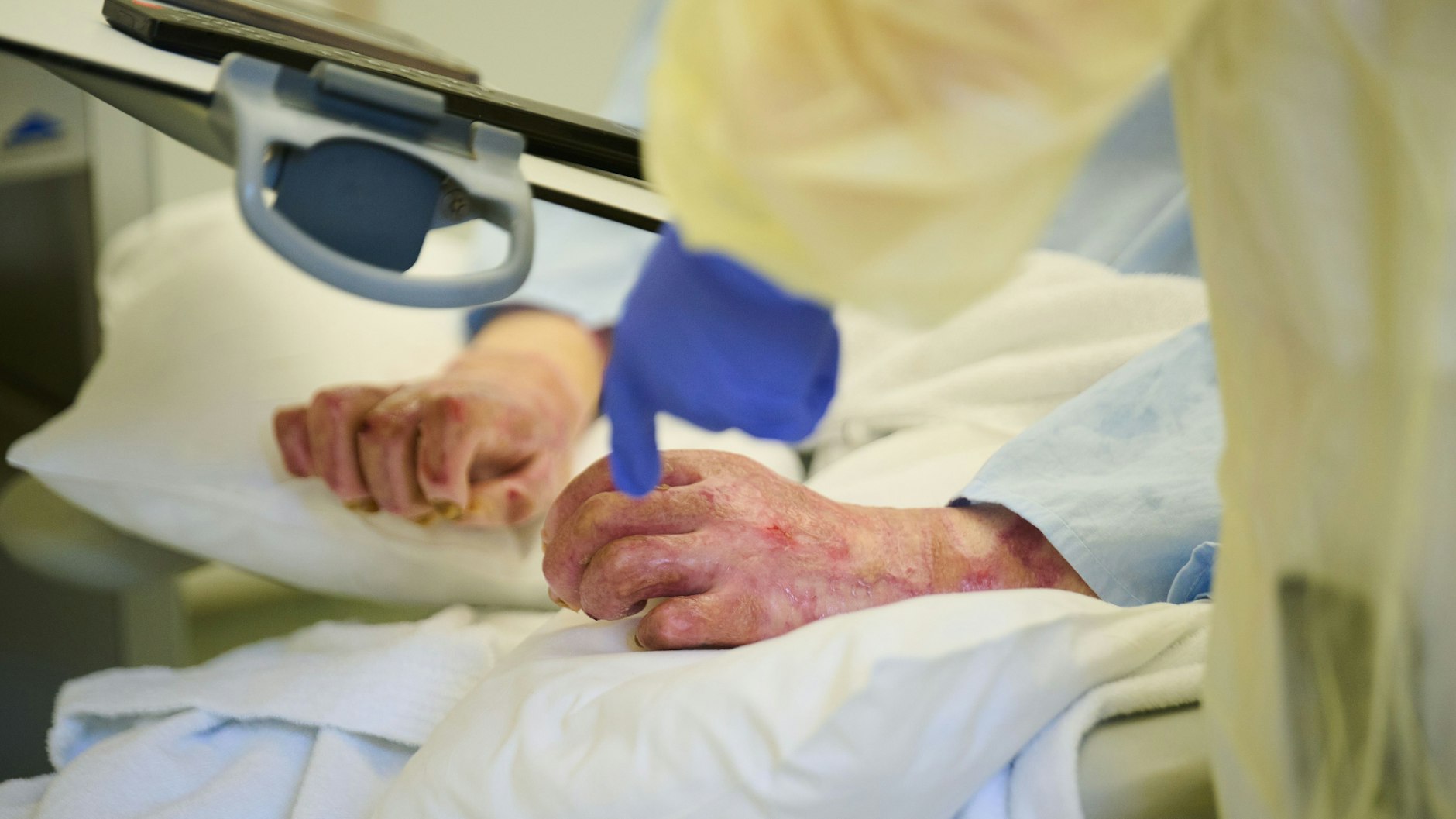 Die vernarbten Hände eines ukrainischen Soldaten, der mit schweren Verbrennungen im Unfallkrankenhaus Berlin behandelt wird.