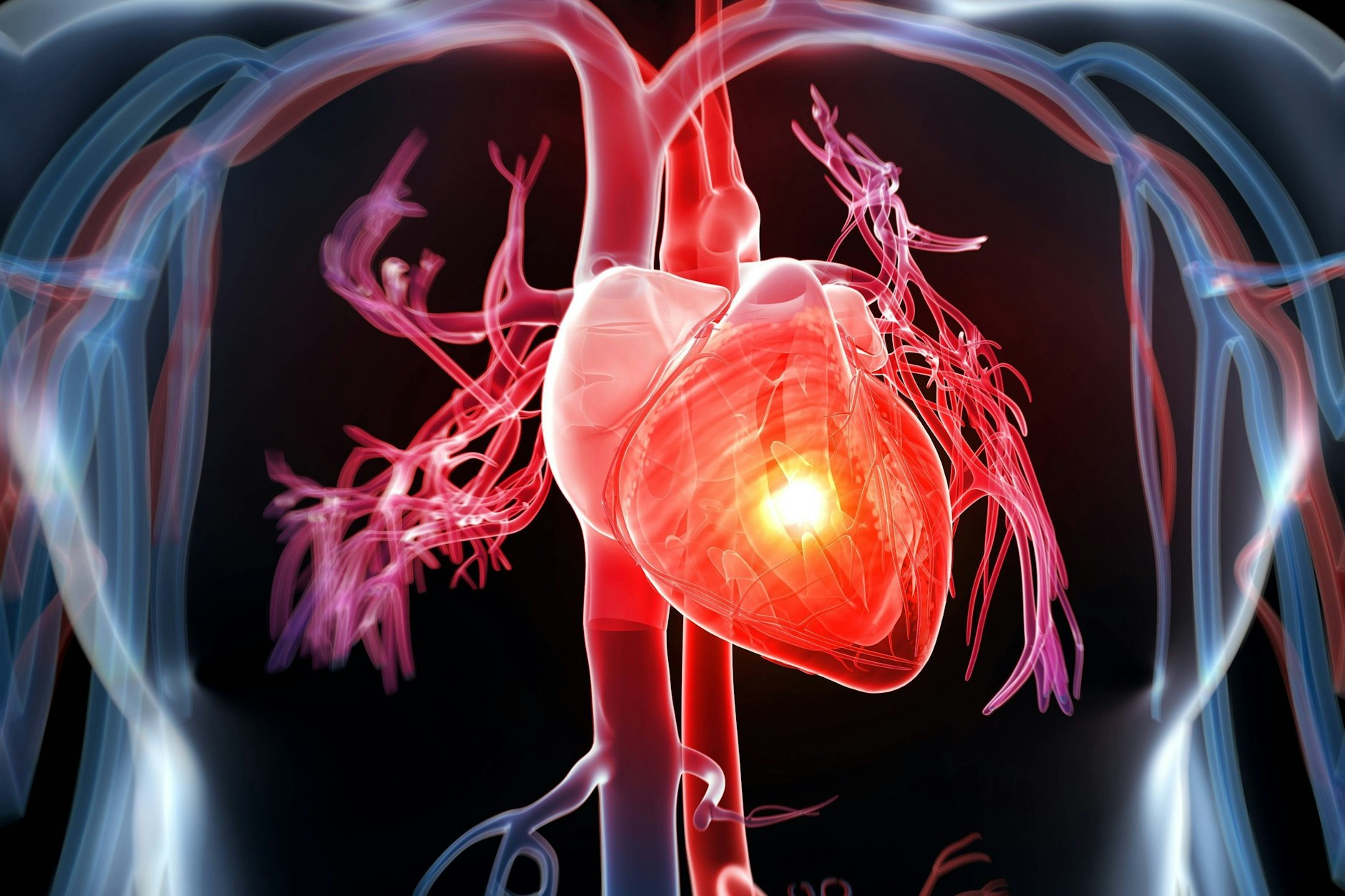 Herzinfarkte sind eine häufige Todesursache.