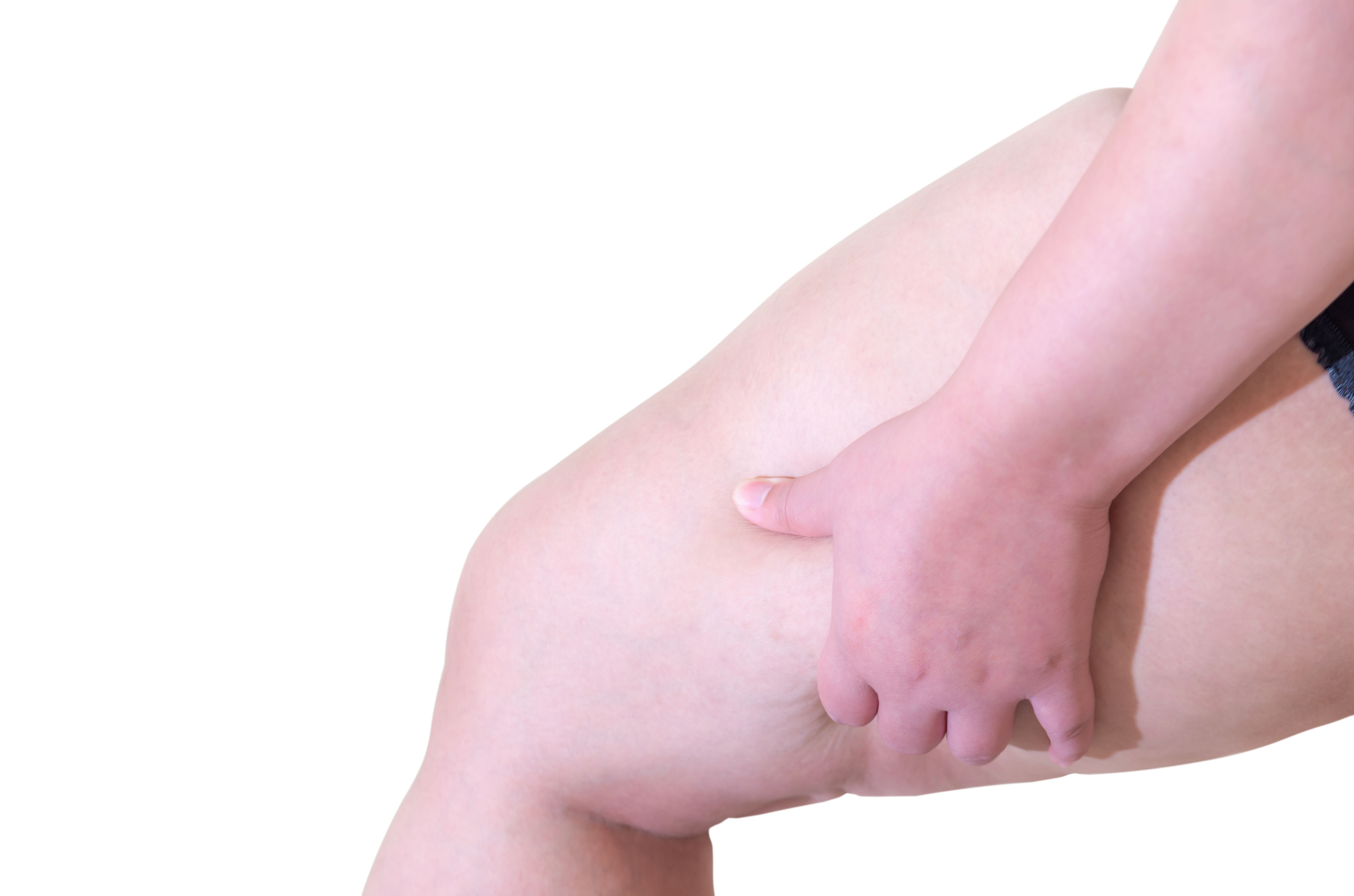 Neue Studie: Cellulite schützt gegen Demenz und Schlaganfall