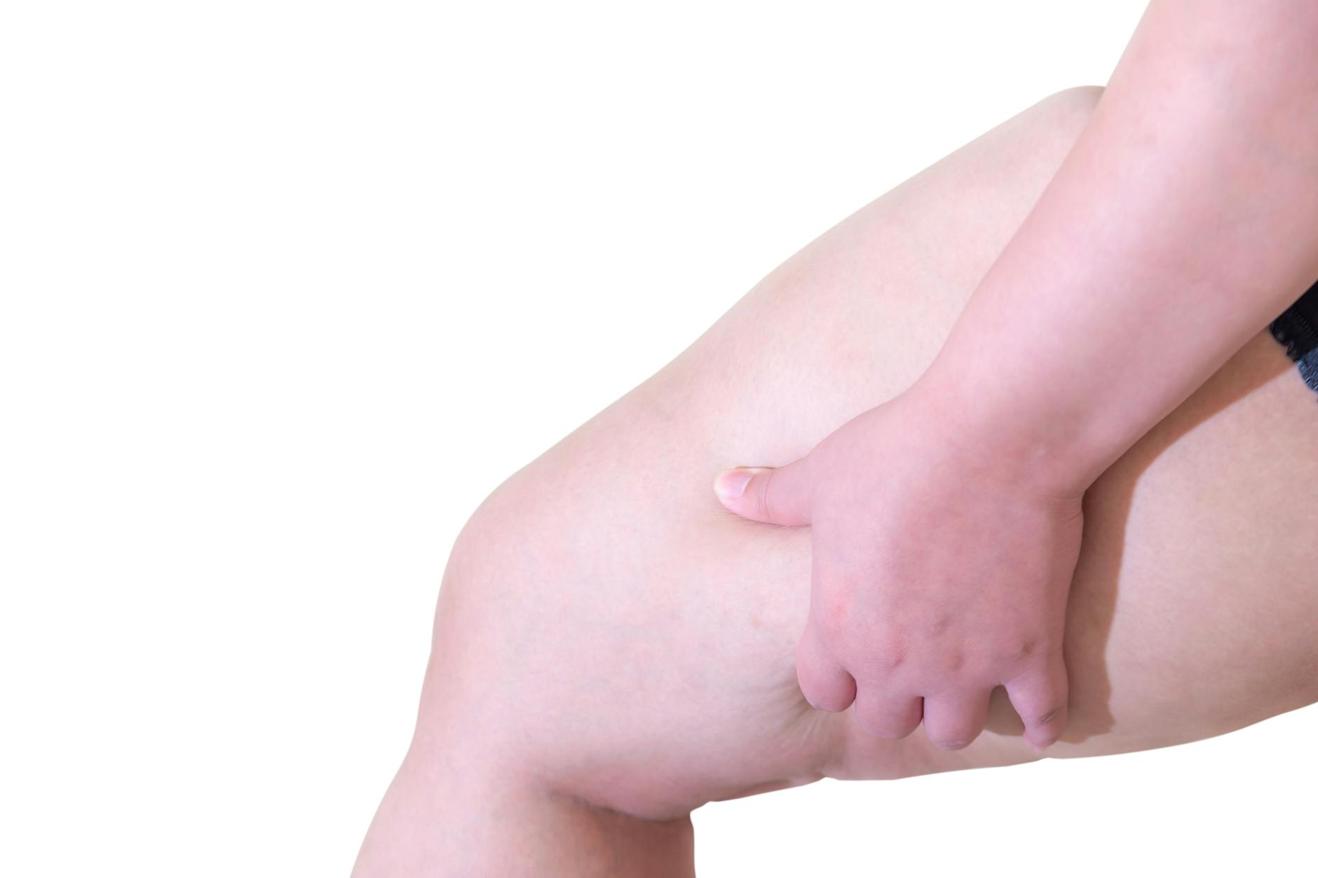 In Zeiten des Social-Media-Perfektionswahns hassen Frauen Cellulite in ihren Problemzonen mehr denn je.