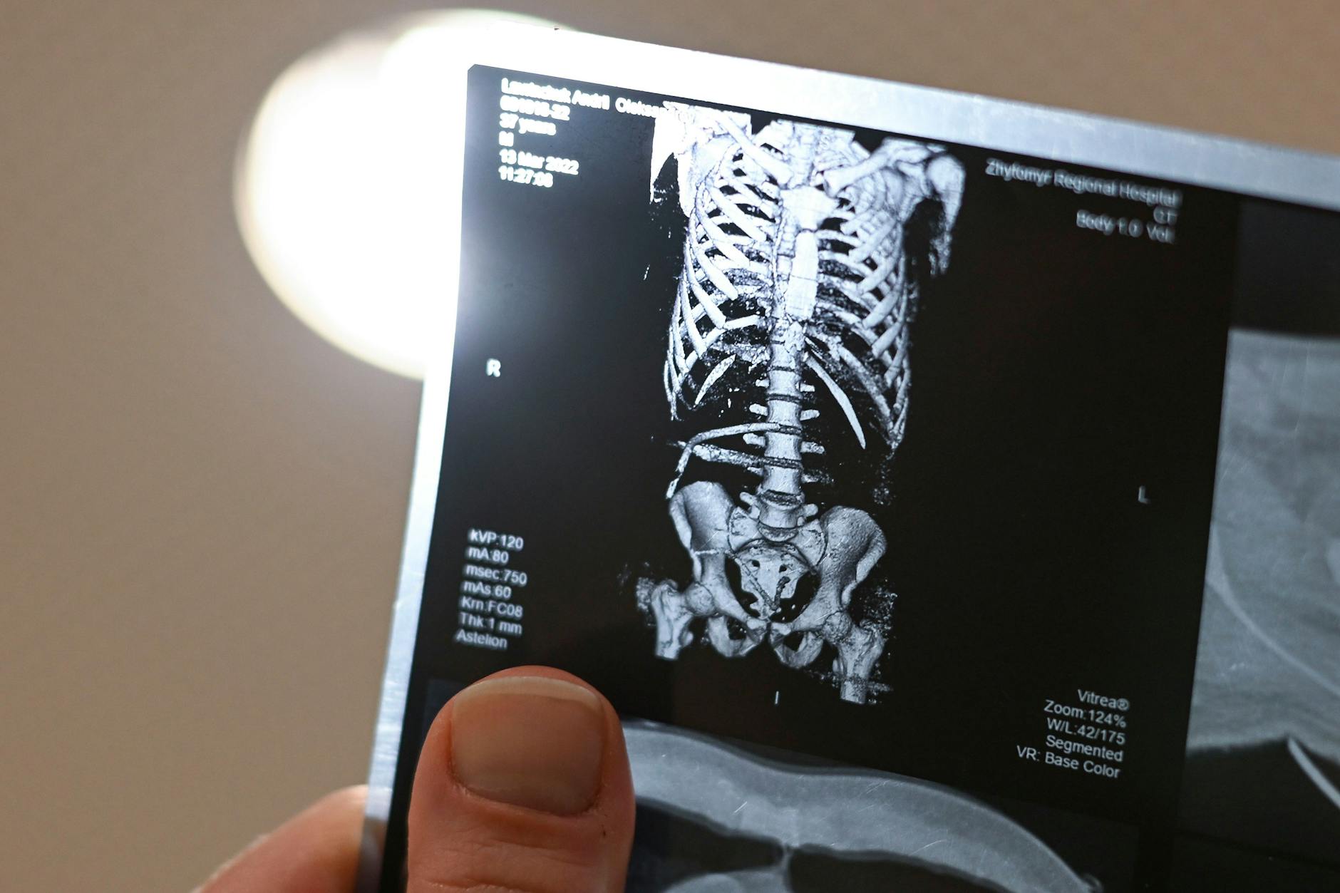 Eines der Röntgenbilder, die in einem Militärkrankenhaus in der Ukraine entstanden sind. Die Aufnahme zeigt die gebrochenen Wirbel.