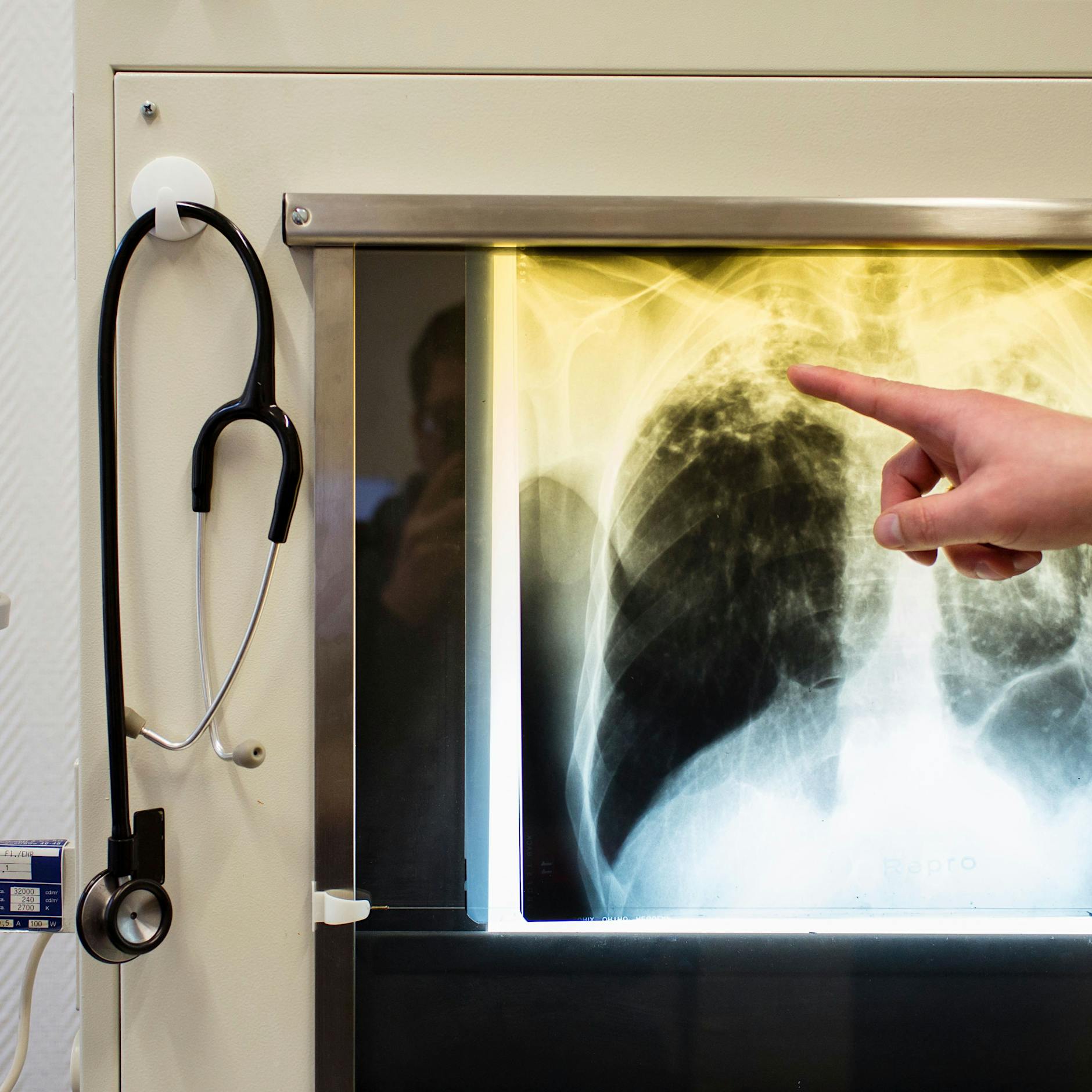 Lungentuberkulose in Chemnitz ausgebrochen: Pflegeschülerin erkrankt, Gesundheitsamt sucht Kontaktpersonen