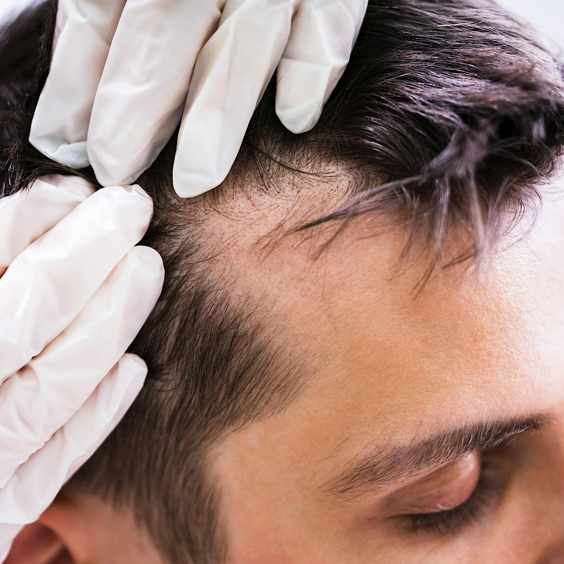 Trockene oder fettige Kopfhaut: Wie wird man Schuppen wieder los?