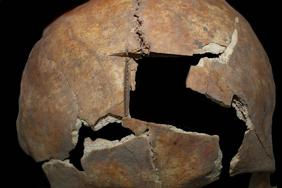 Diese Nahaufnahme zeigt den Schädel mit der Trepanation.