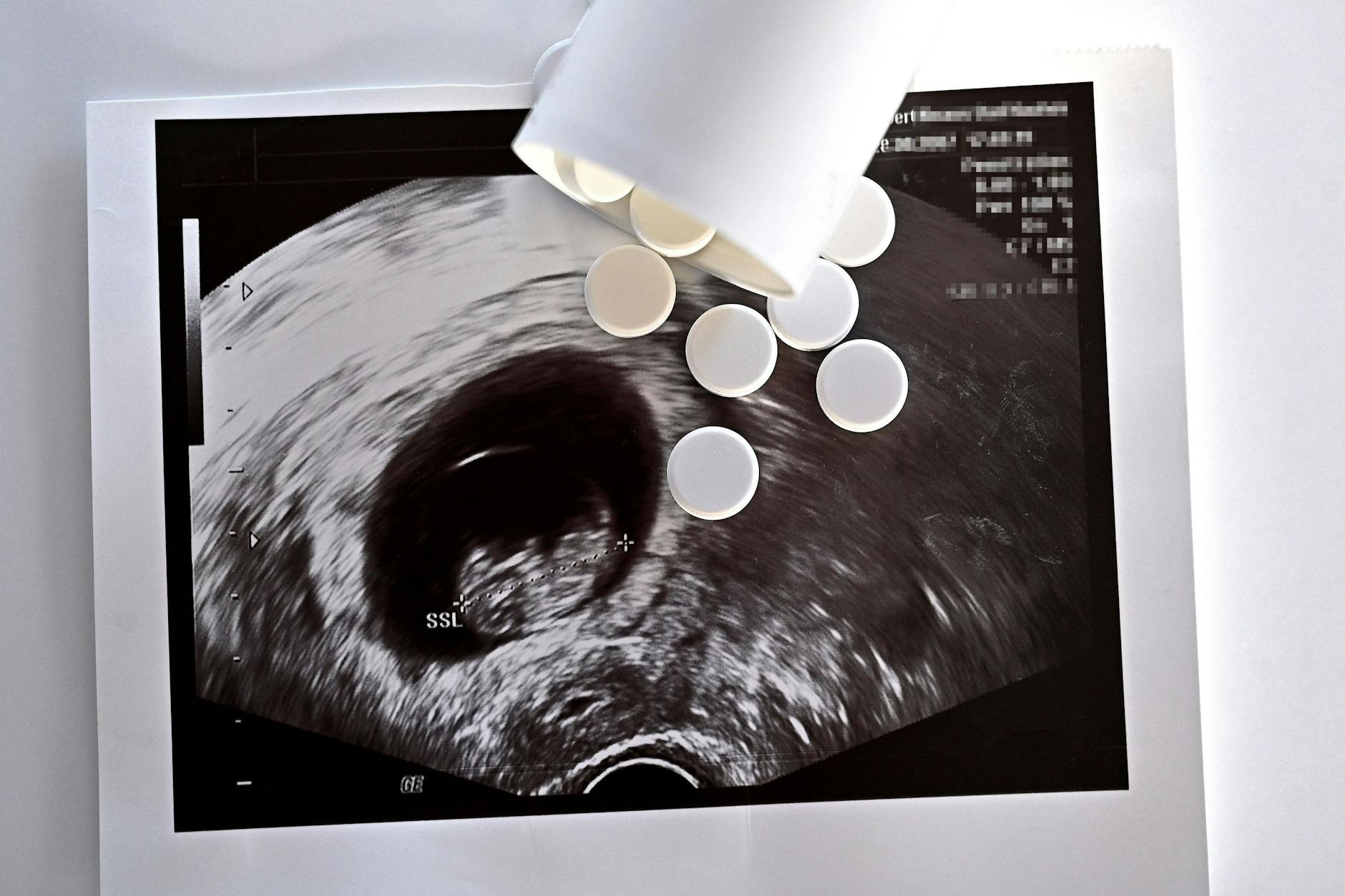 Tabletten auf einem Ultraschallbild. Die Zahl der Schwangerschaftsabbrüche steigt. 