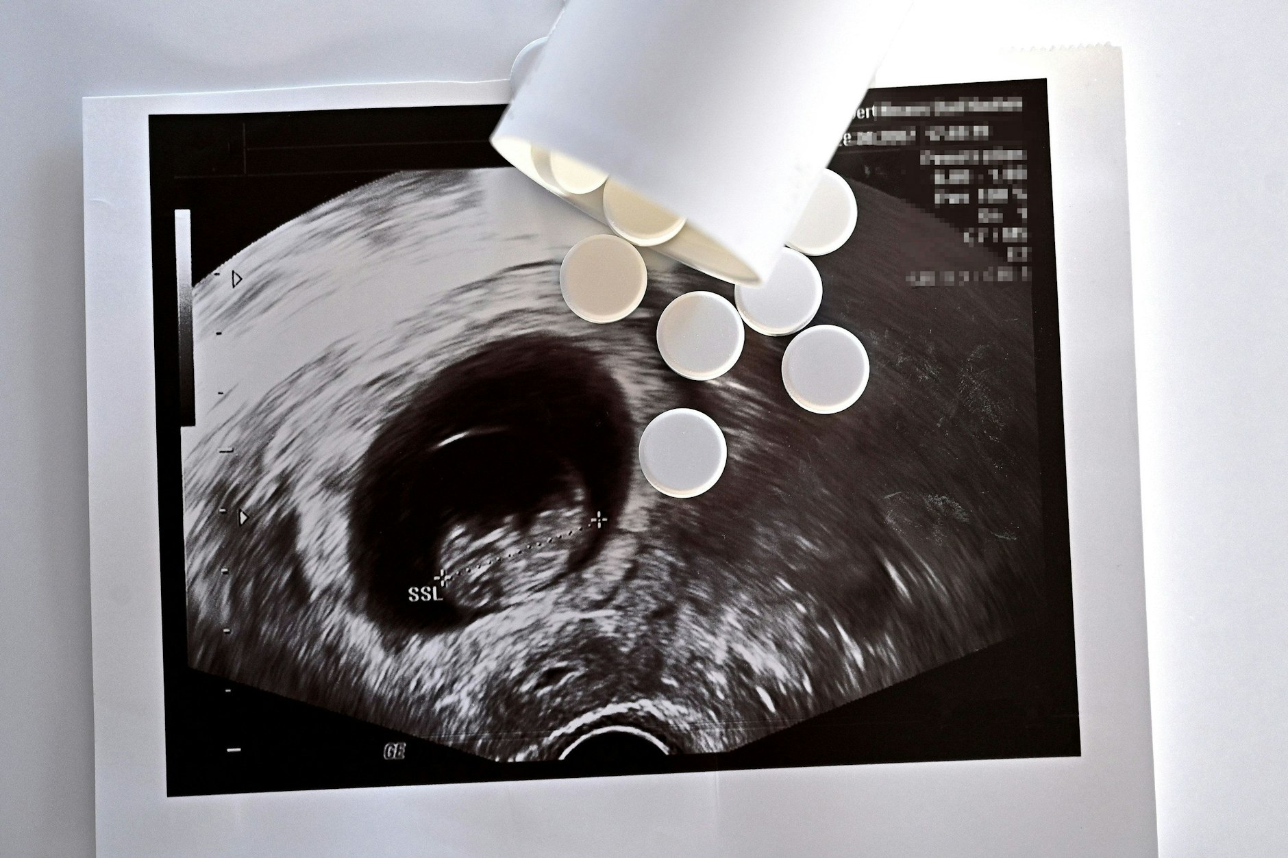 Tabletten auf einem Ultraschallbild. Die Zahl der Schwangerschaftsabbrüche steigt.&nbsp;