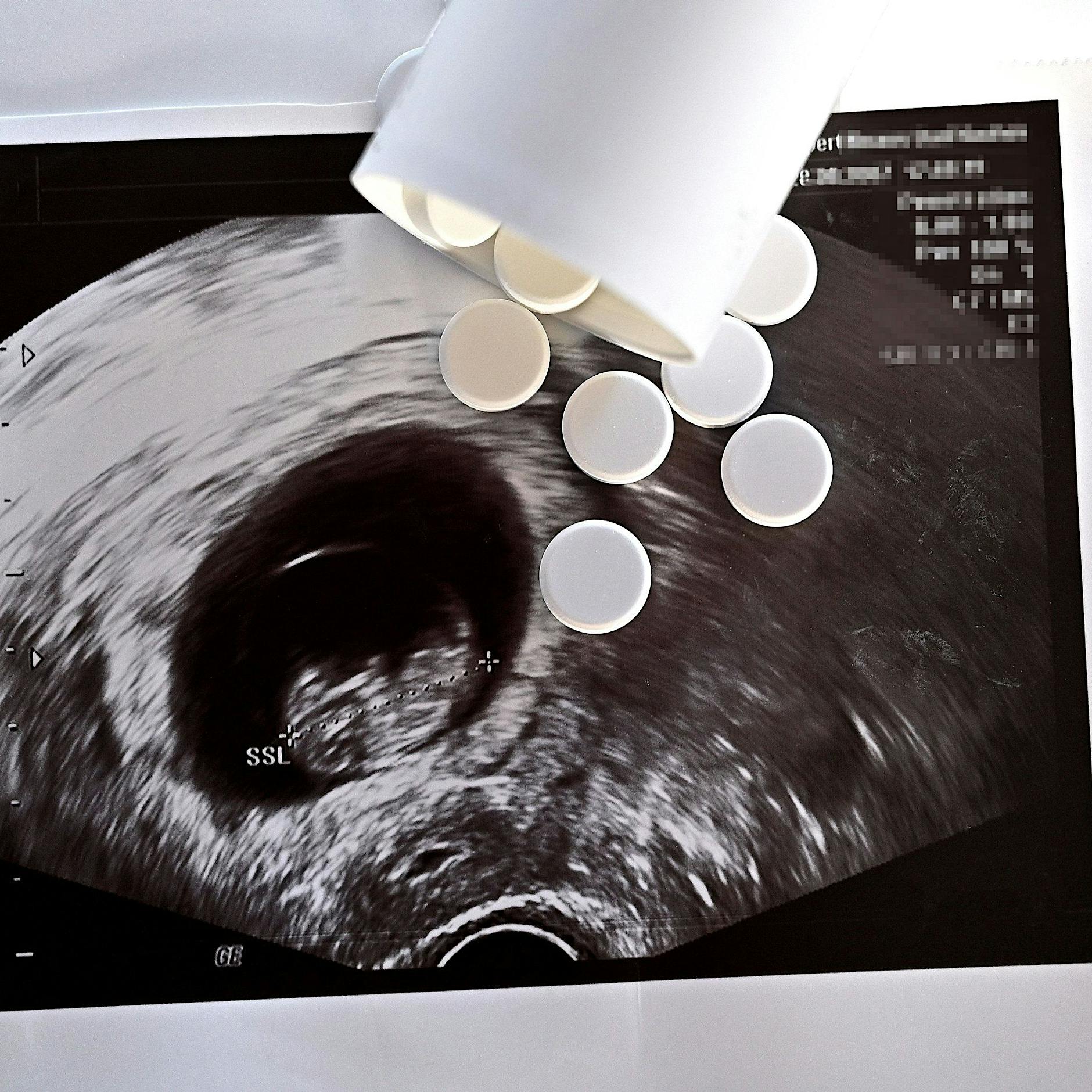 2022: Deutlich mehr Schwangerschaftsabbrüche in Deutschland