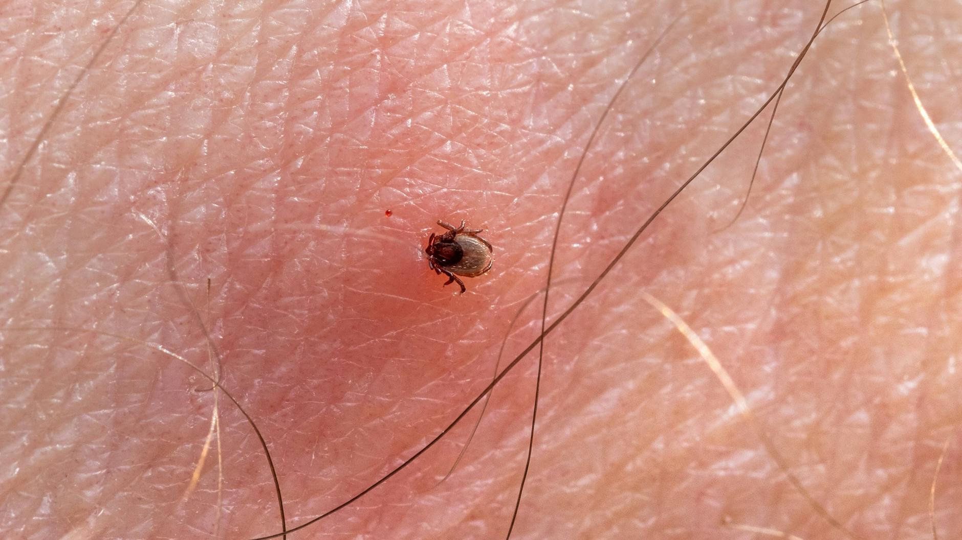 Die runde Hautrötung nach einem Zeckenstich