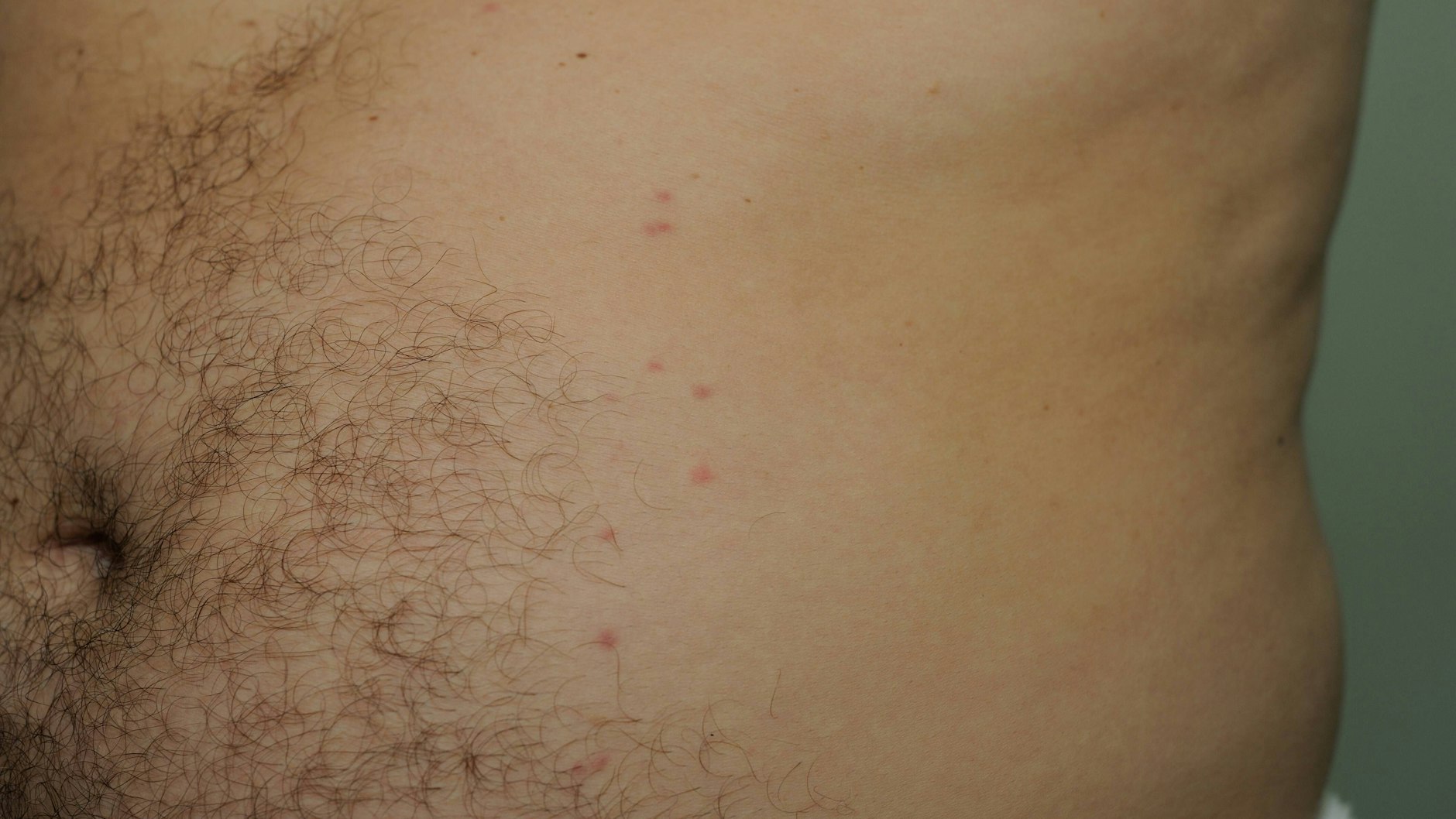 Bisse von Bettwanzen treten oft linienförmig auf und jucken.