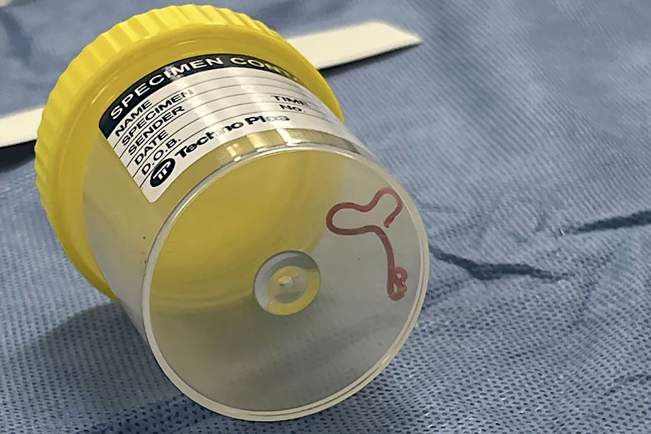 In einem Krankenhaus in Canberra haben Ärzte einen lebendigen, acht Zentimeter langen Rundwurm aus dem Gehirn einer 64-jährigen Frau entfernt.&nbsp;&nbsp;