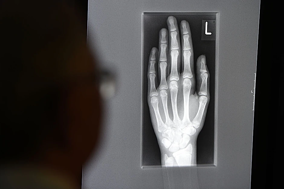 Ein Röntgenbild auf einem Bildschirm zeigt die linke Hand eines jungen Menschen. Kann Künstliche Intelligenz bald Diagnosen stellen?