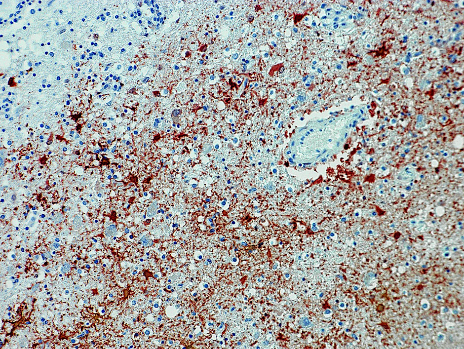 ARCHIV - Die undatierte Aufnahme zeigt einen Anitkörpernachweis zum Borna-Virus im Gewebe.  penmedizin/dpa