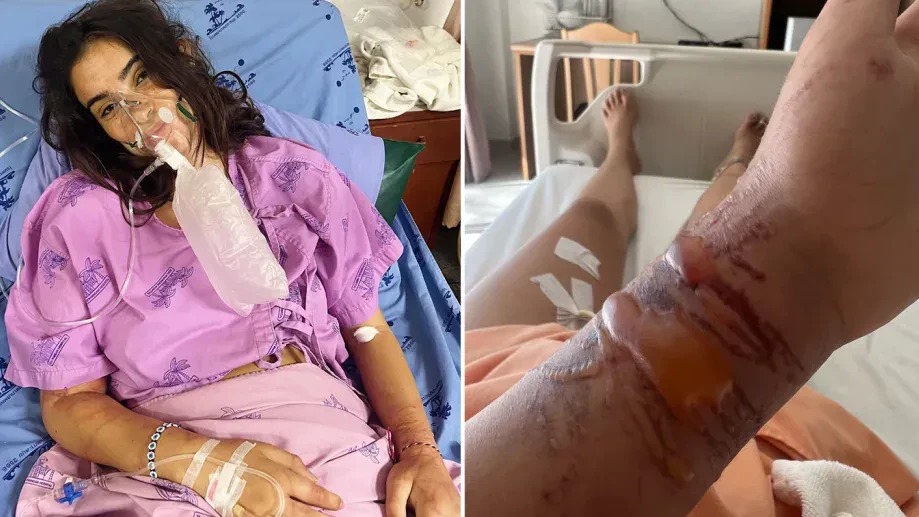Die Haut von Zoe Cahill ist über und über mit roten Narben bedeckt.