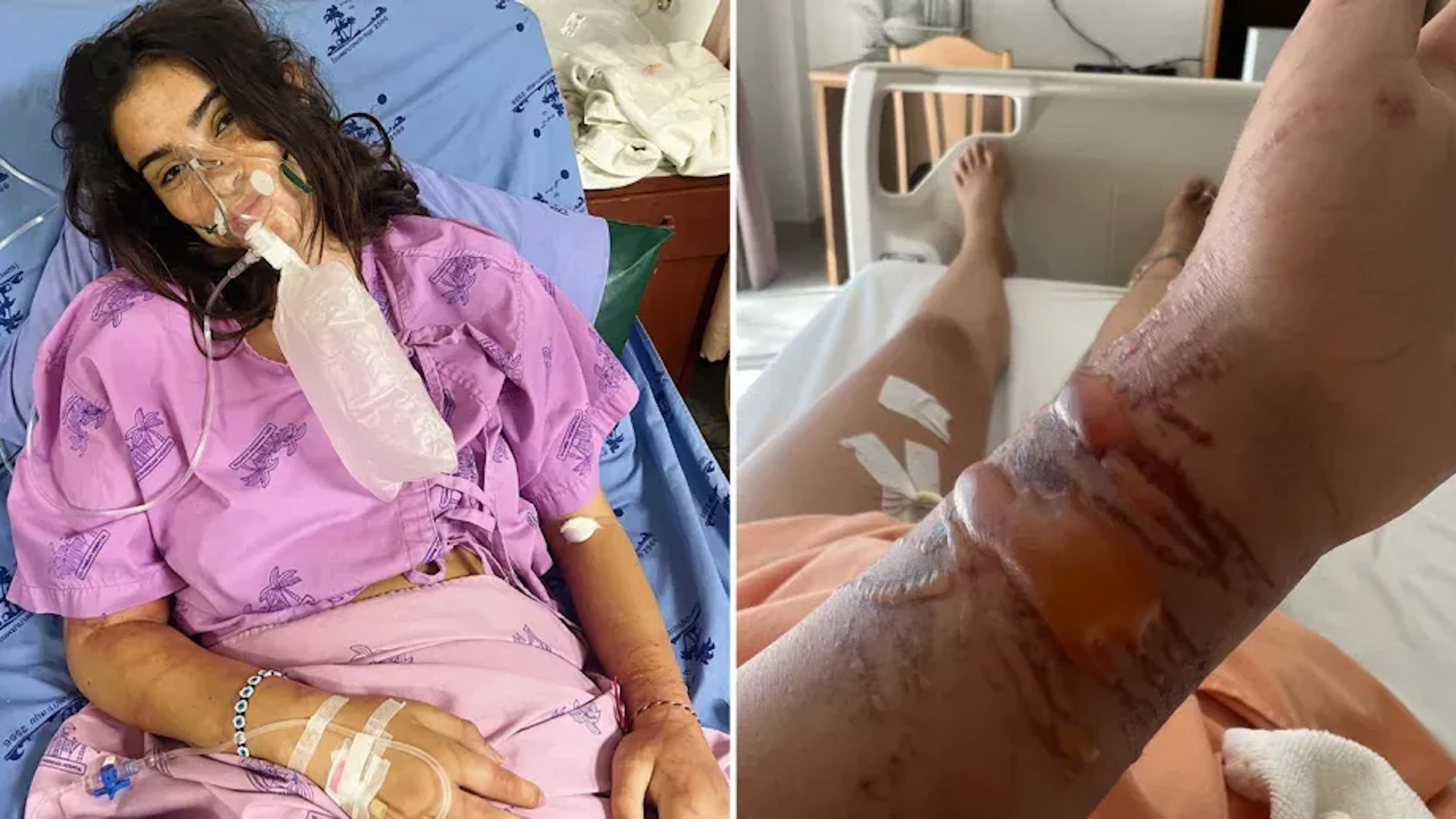 Die Haut von Zoe Cahill ist über und über mit roten Narben bedeckt.