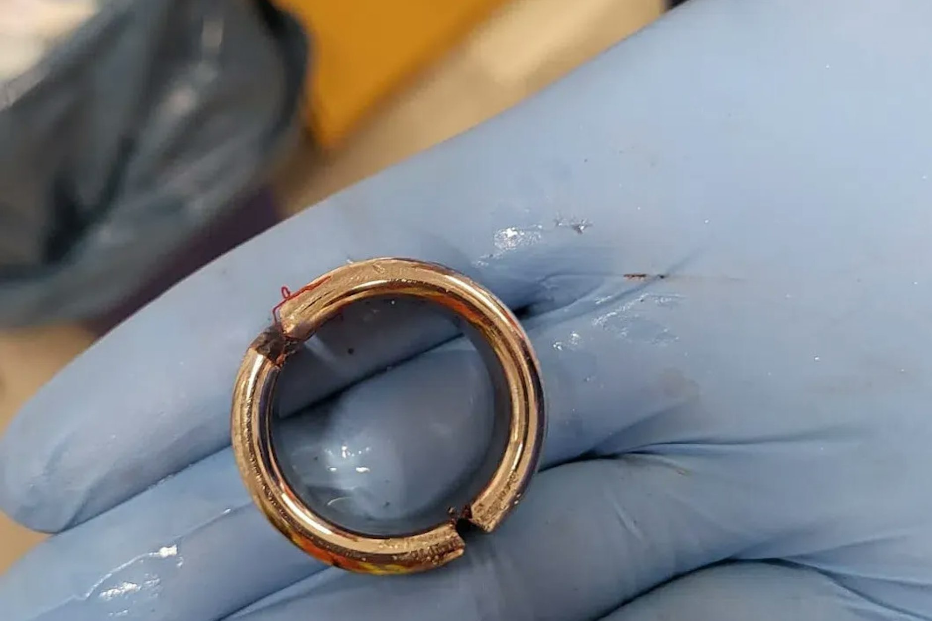 Dies ist der Metallring, wegen dem die Feuerwehrleute in die Klinik gerufen wurden.