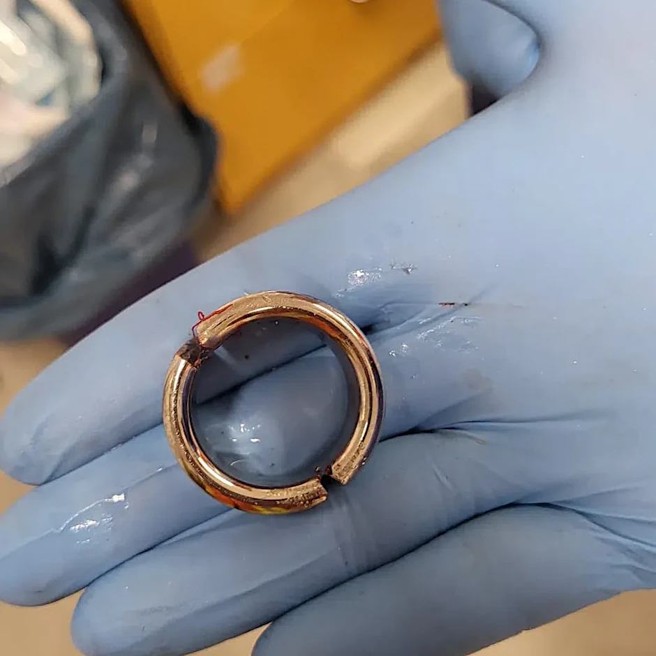 Dies ist der Metallring, wegen dem die Feuerwehrleute in die Klinik gerufen wurden.