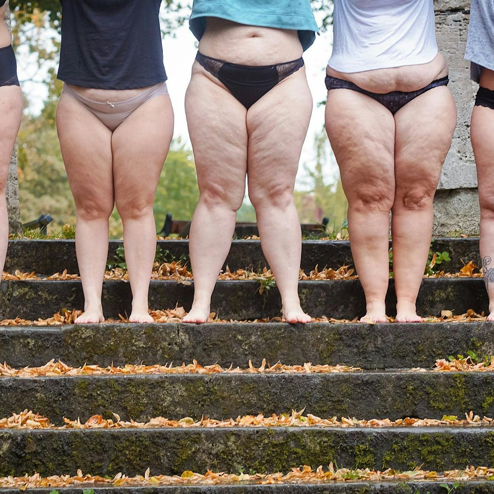 Verdacht auf Lipödem: Arzt, Behandlung, Kosten – DAS müssen Sie wissen