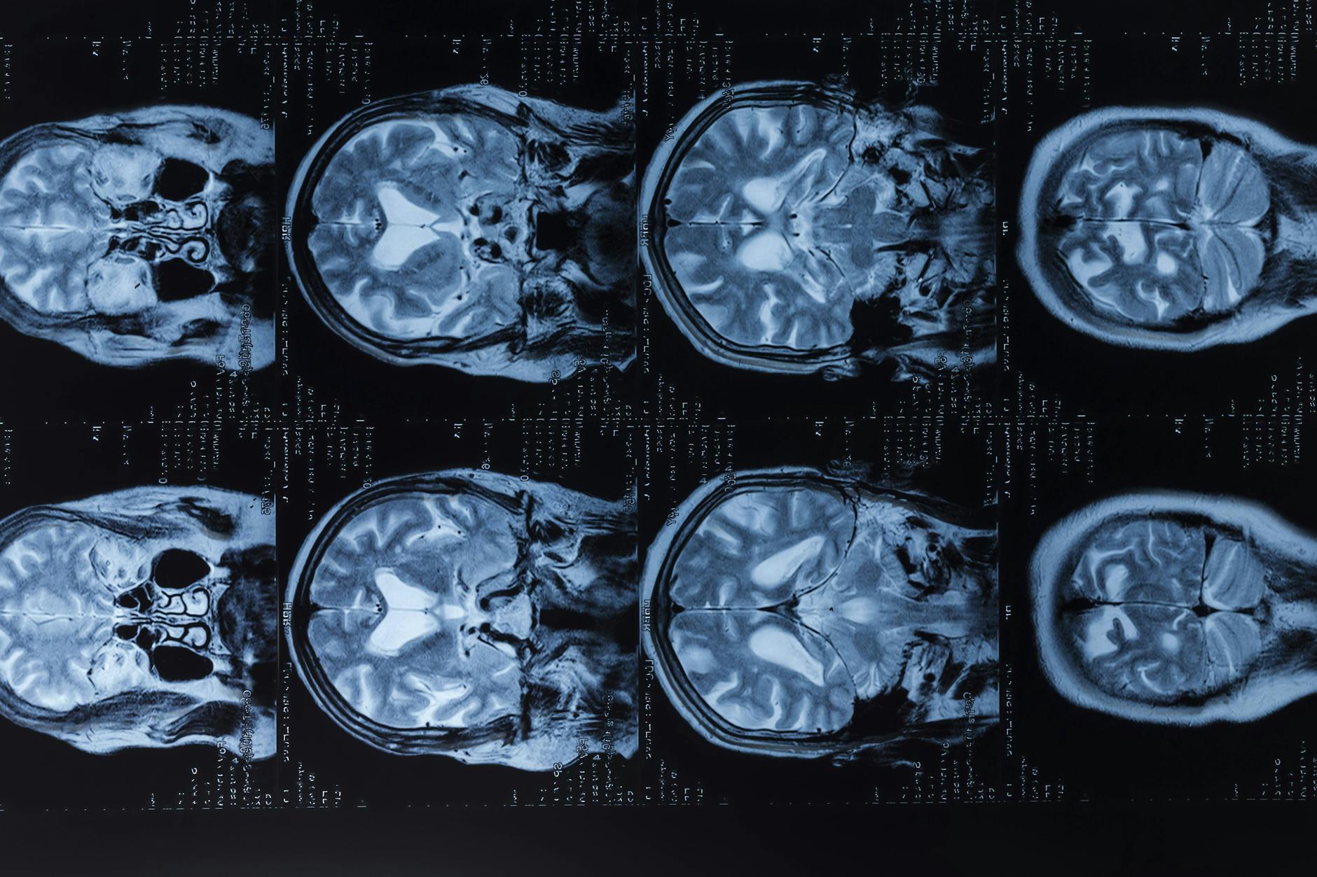 Das MRT eines menschlichen Gehirns