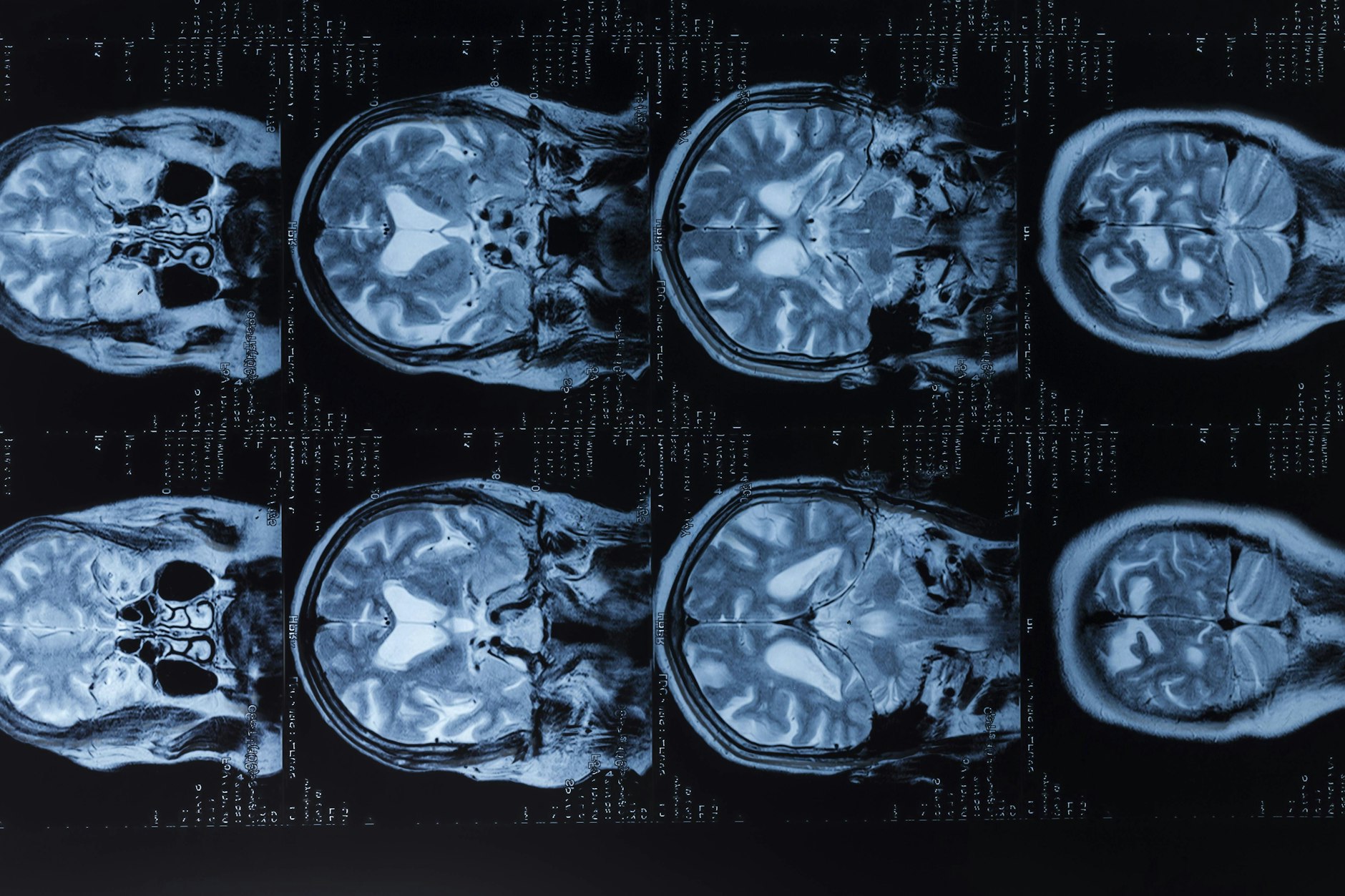 Das MRT eines menschlichen Gehirns