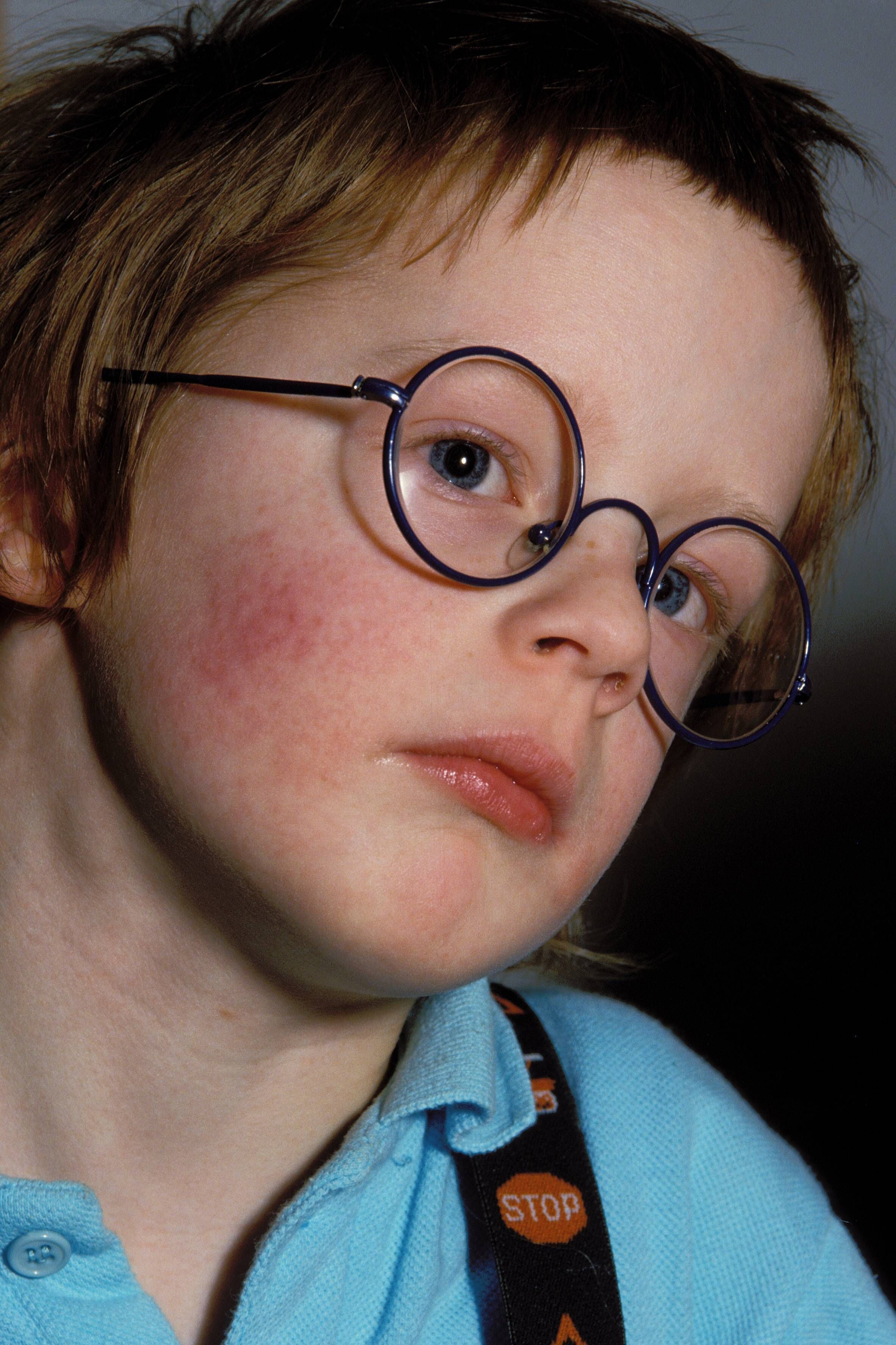 Ringelröteln: Was Eltern wissen sollten. Berliner Chefarzt klärt auf