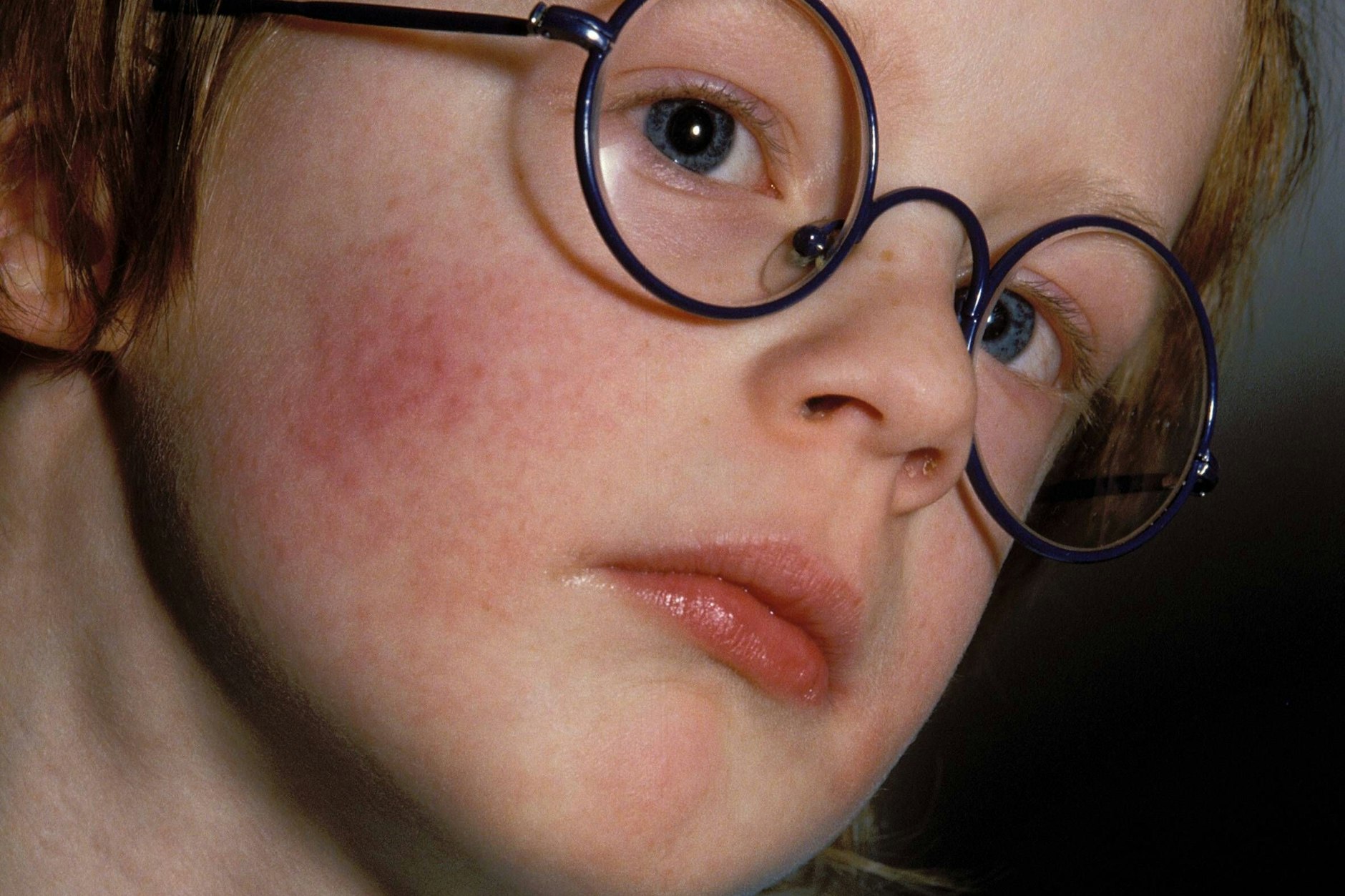 Ringelröteln beginnen meist mit einem großflächigen Hautausschlag auf den Wangen.