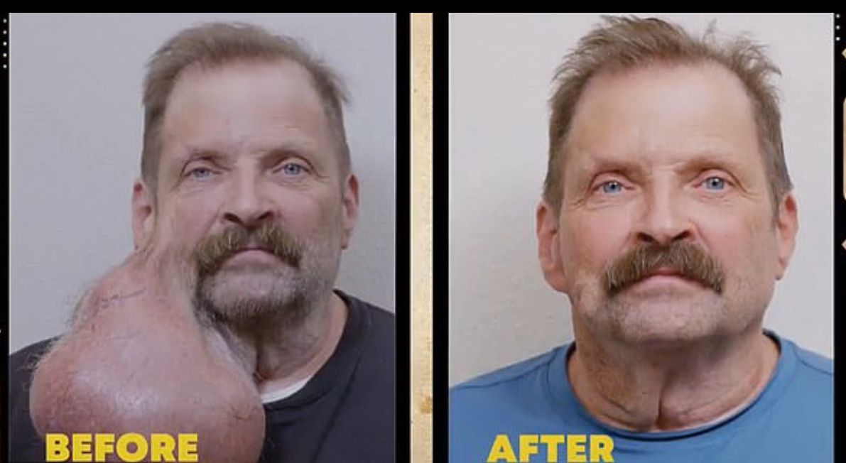 Image - Aus kleinem Pickel wurde 2,5 Kilo-Tumor am Hals