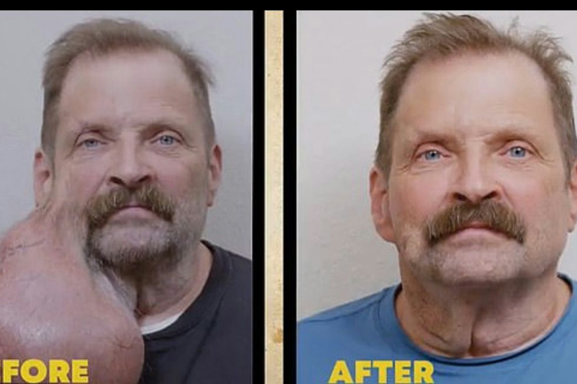 Der Tumor war fast so groß, wie Tim L.s Gesicht. Das rechte Bild zeigt Tim nach der OP.