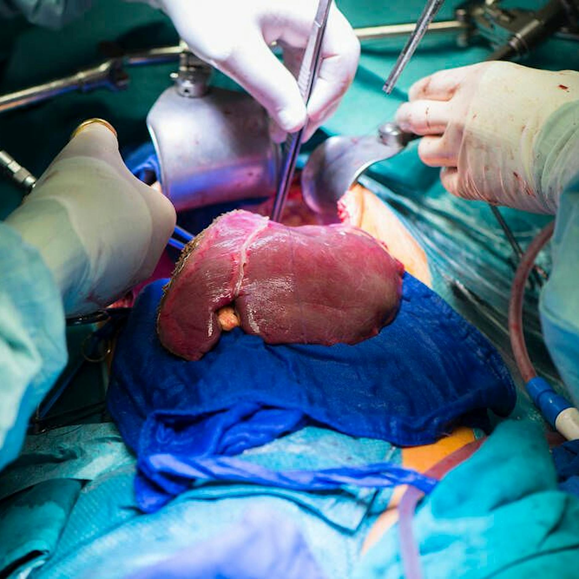 Berliner Charité an Studie beteiligt: Alterungsprozess bei Transplantation älterer Organe stoppen