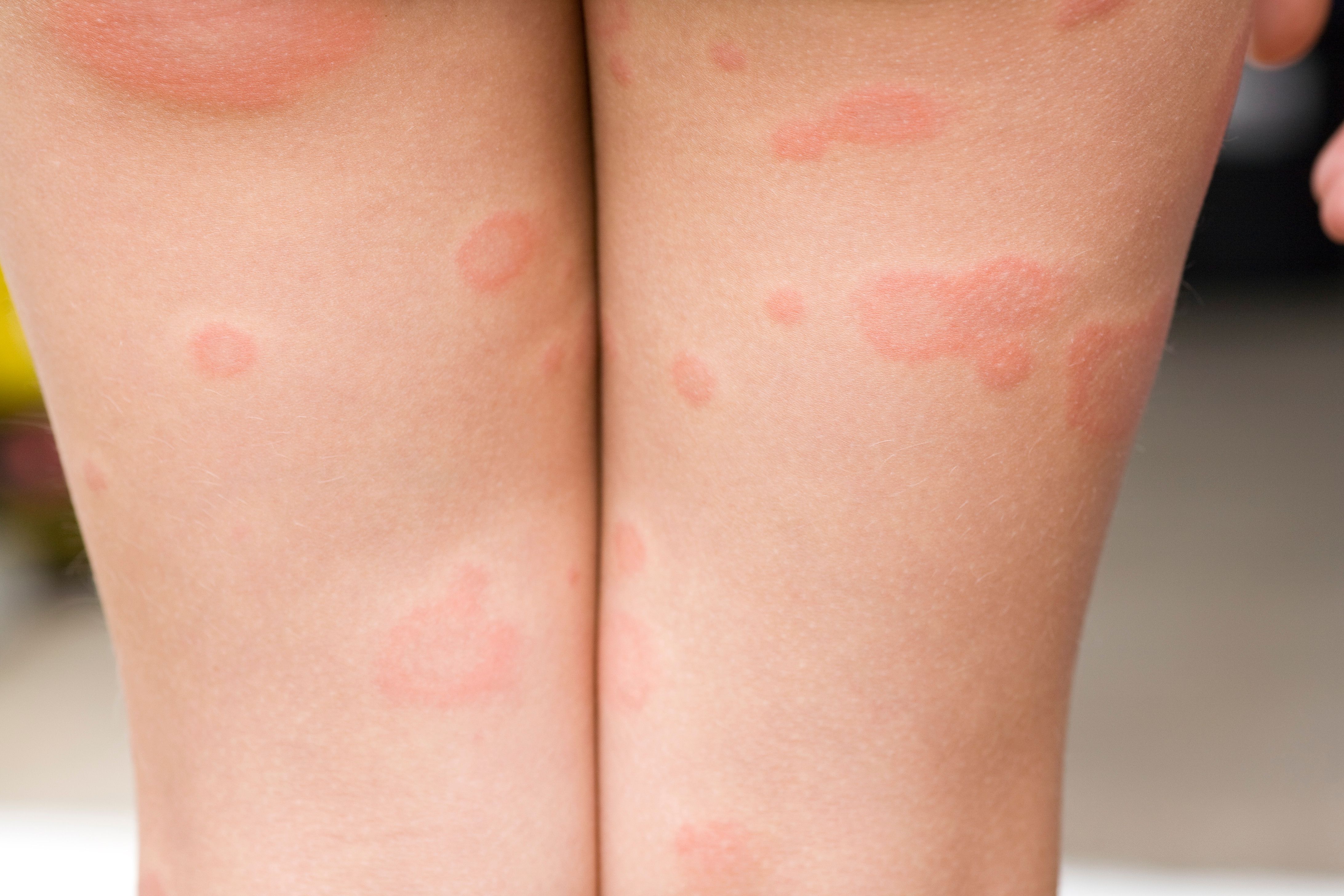 Ringelröteln: Deutlich mehr Fälle – Gefahr für Schwangere