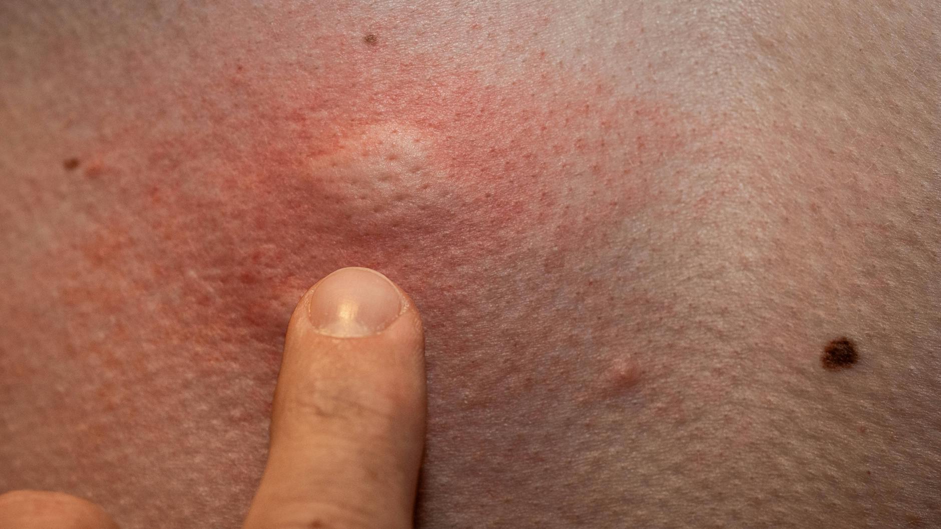 Normalerweise bilden sich nach einem Mückenstich rote, juckende Quaddeln. Doch nach einem Stich können auch andere Symptome auftreten.