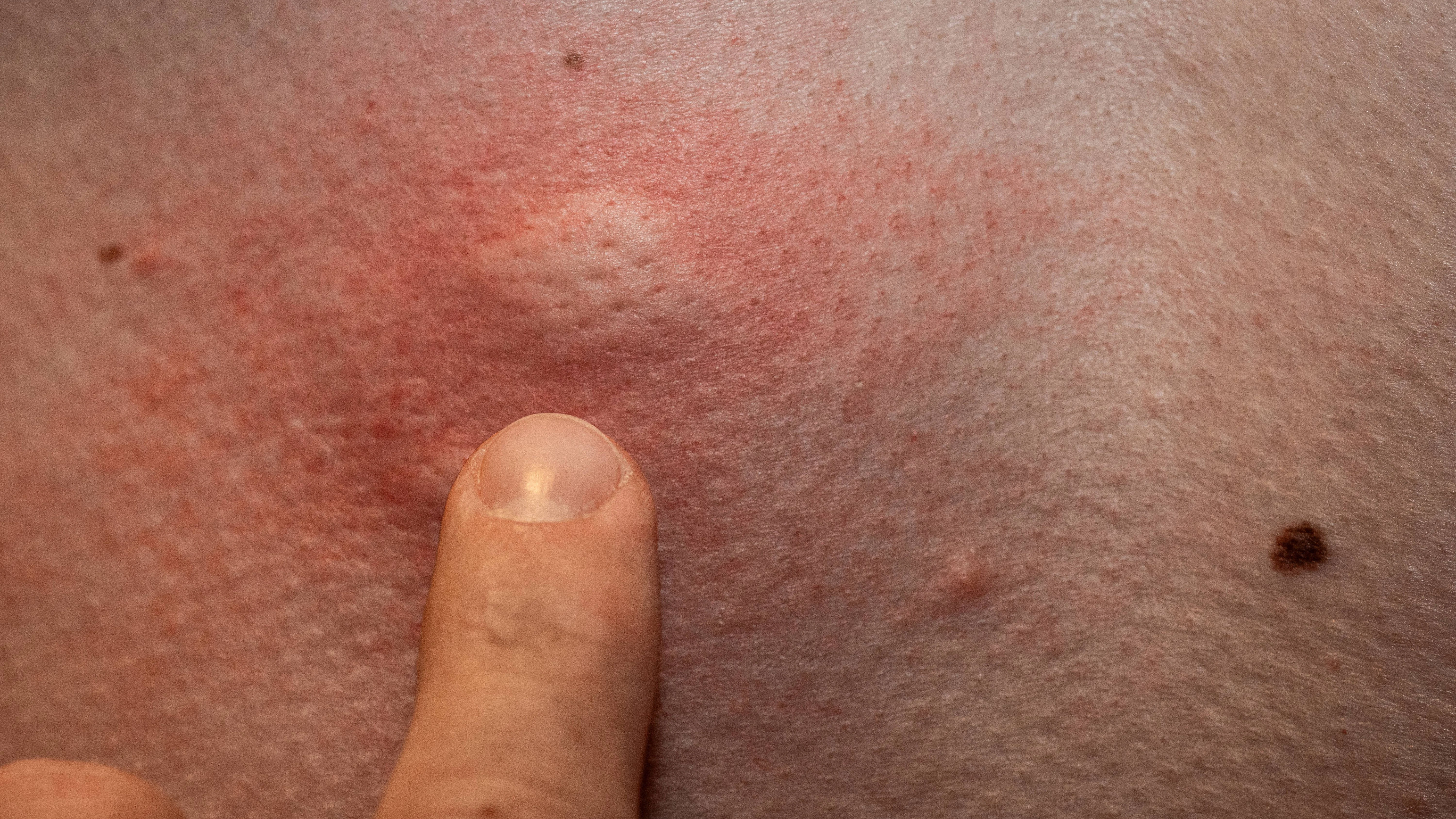 Normalerweise bilden sich nach einem Mückenstich rote, juckende Quaddeln. Doch nach einem Stich können auch andere Symptome auftreten.