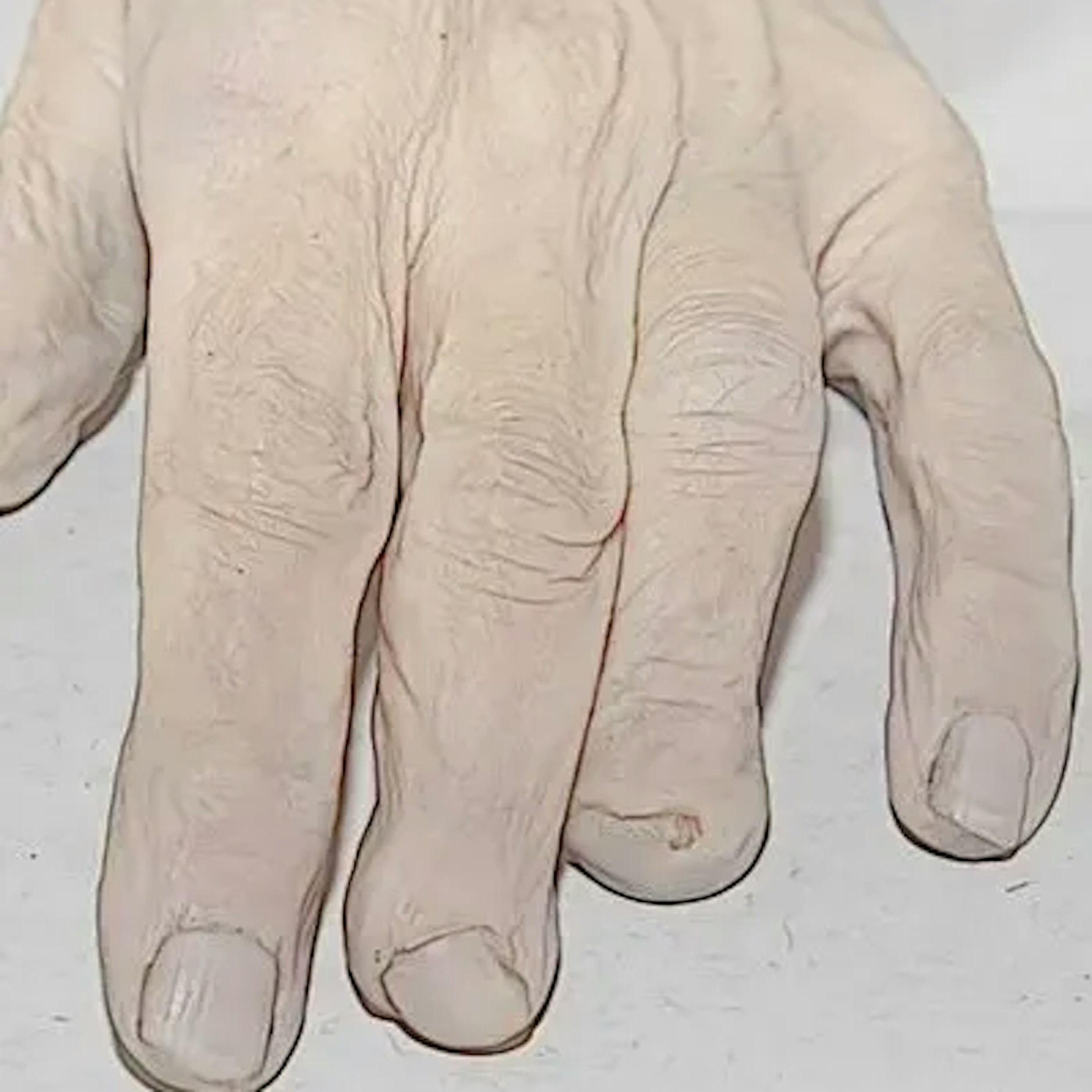 Die Frau hatte diese auffälligen Deformierungen an zwei Fingernägeln.
